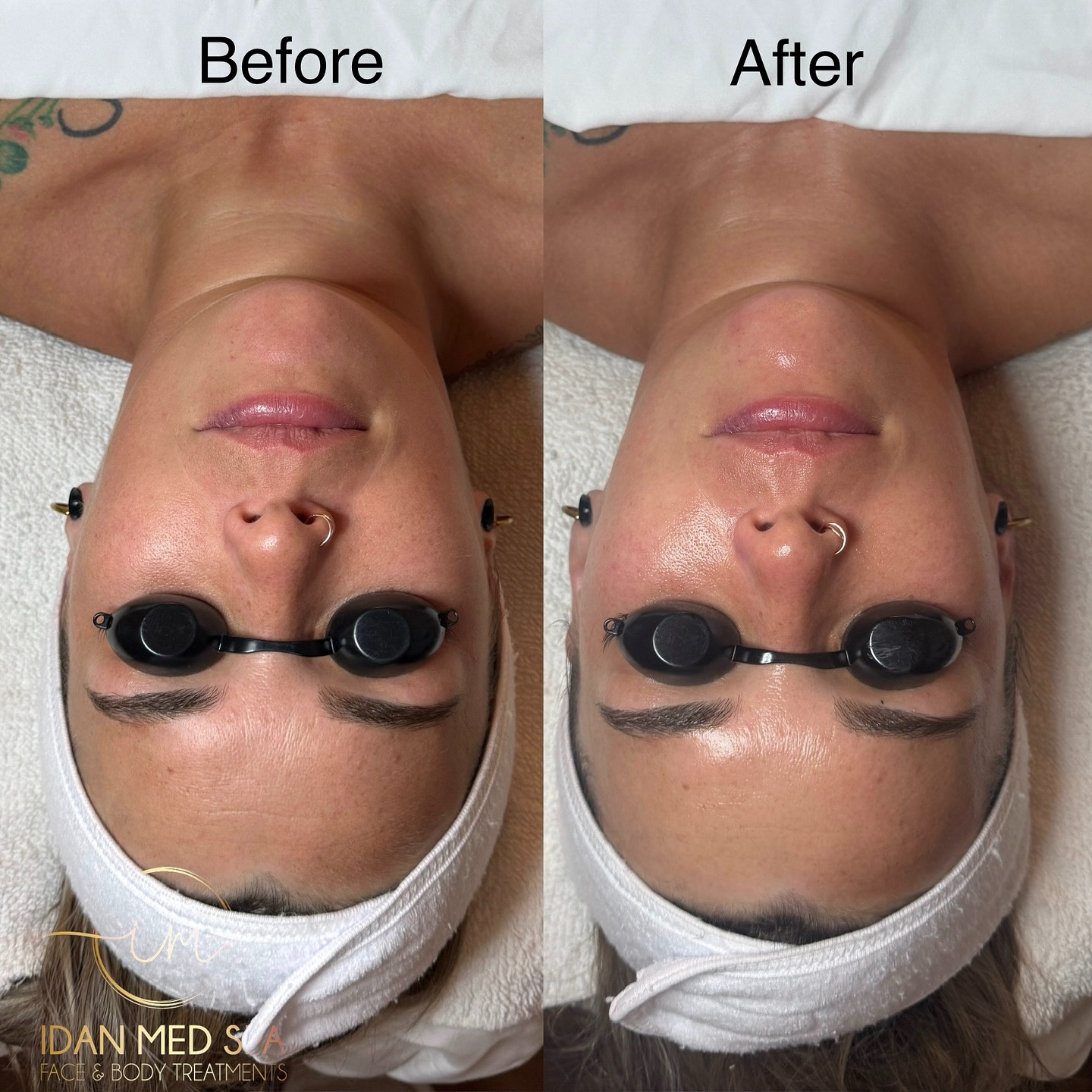 Hydro Facial Magic
Just one treatment and the difference speaks for itself!
Deep cleansing, exfoliation, hydration, and instant glow all in under an hour.
Your skin deserves this kind of love 💆♀️
📍Idan Med Spa – San Francisco & Encino
💌 Book your appointment today and glow from the very first facial!
#HydroFacial #FacialGlow #BeforeAndAfter #GlowingSkin #SkincareGoals #HydrationBoost #HealthySkin #IdanMedSpa #SkincareRoutine #FacialTreatment #DeepCleaningFacial #HydroFacialResults #SelfCare #CleanSkin #InstantGlow #SkincareClinic #BeautyCare #CaliforniaSpa #SanFranciscoSpa #EncinoSpa