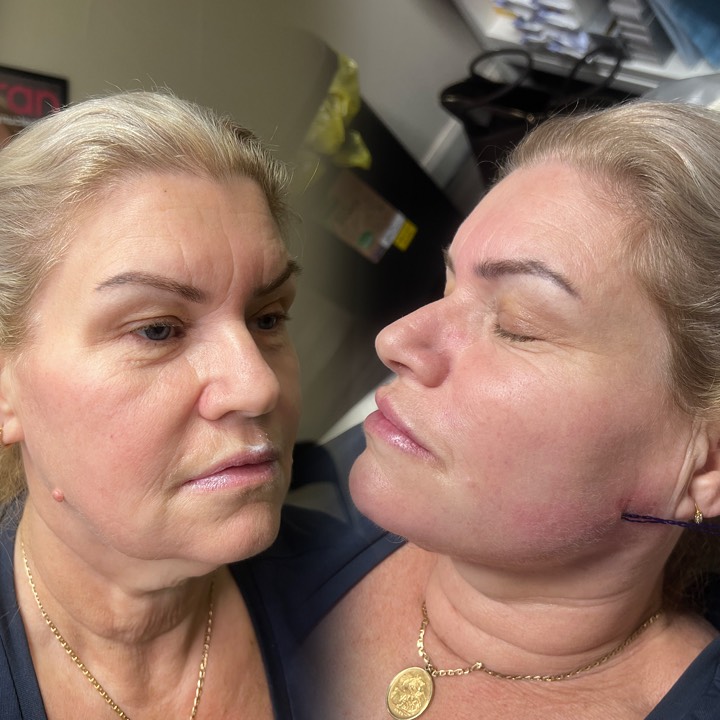 ✨ Lift • Define • Glow ✨
Cogs & Threads paired with Filler for the ultimate rejuvenation — expertly performed by Senior Practitioner Rachel 💉
DM to book your consultation 💗
#TheBeautyLabNorthEast #CogsAndThreads #DermalFiller #FacialRejuvenation #PDOThreads #Aesthetics #SkinLift #NorthEastAesthetics #beautyclinic
