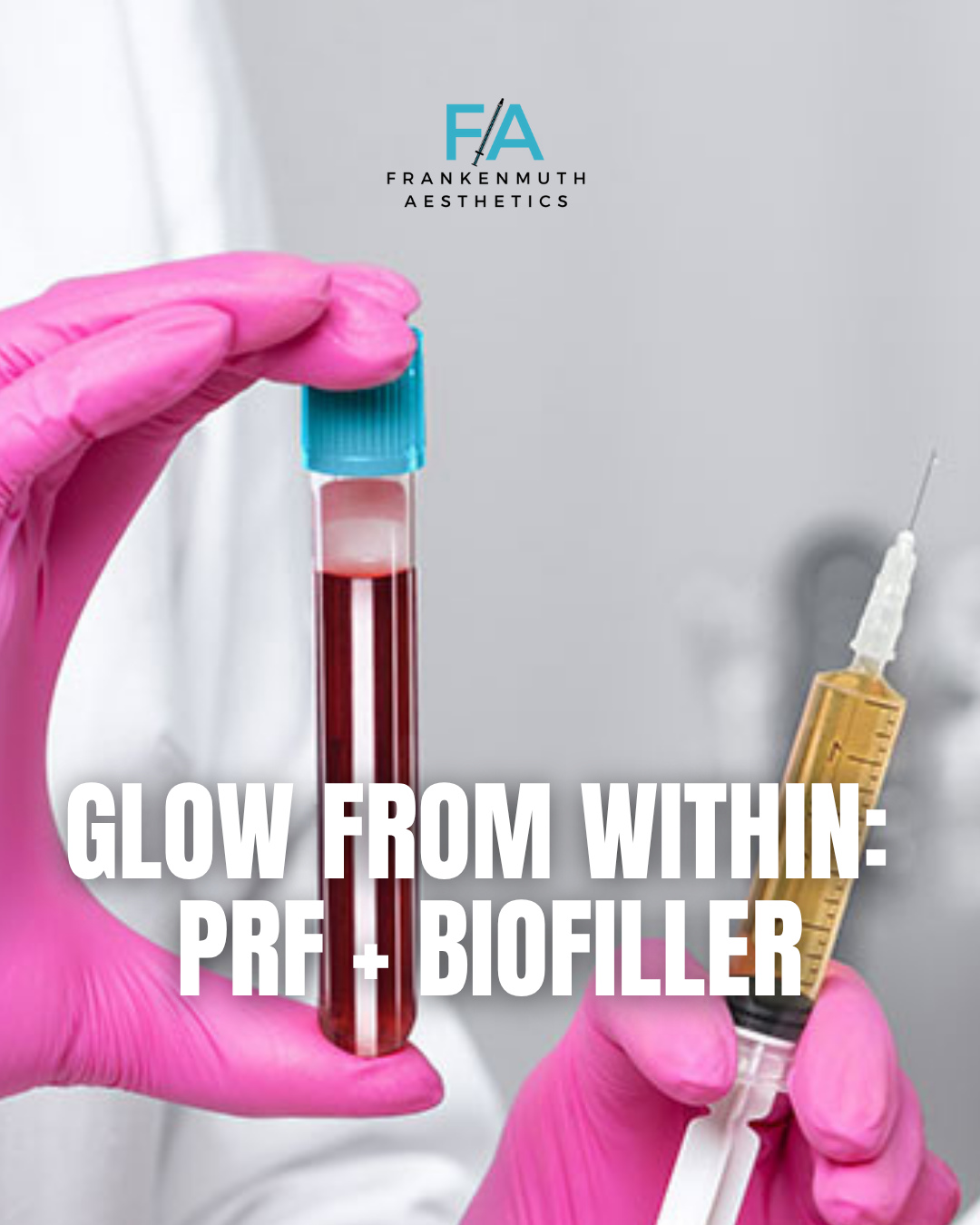Your body, your glow. ✨ This is the future of regenerative aesthetics.
Harness the power of your own body to refresh and rejuvenate your skin from within. We're talking about Platelet-Rich Fibrin (PRF) and BioFiller gel—two innovative treatments changing the way we think about skin quality.
How does it work? We start with a simple blood draw. From this, we isolate your platelet-rich fibrin, which contains powerful growth factors. This is then used in two ways:
💉 PRF Injections: A fibrin matrix creates a "scaffolding" under the skin, allowing for a slow, steady release of growth factors to stimulate collagen and improve skin health over time.
🧬 BioFiller Gel: The PRF can be processed into a natural gel, providing gentle volume and hydration.
This approach is ideal for tackling concerns like under-eye crepiness, fine lines, and overall skin texture. It's a journey, not a quick fix. Results are gradual, typically achieved over a series of treatments with minimal downtime.
Our clients often report that their skin looks and feels healthier, with a noticeable improvement in texture and firmness.
Ready to explore regenerative aesthetics? Tap the link in our bio to book your consultation and discover if PRF is right for you.
