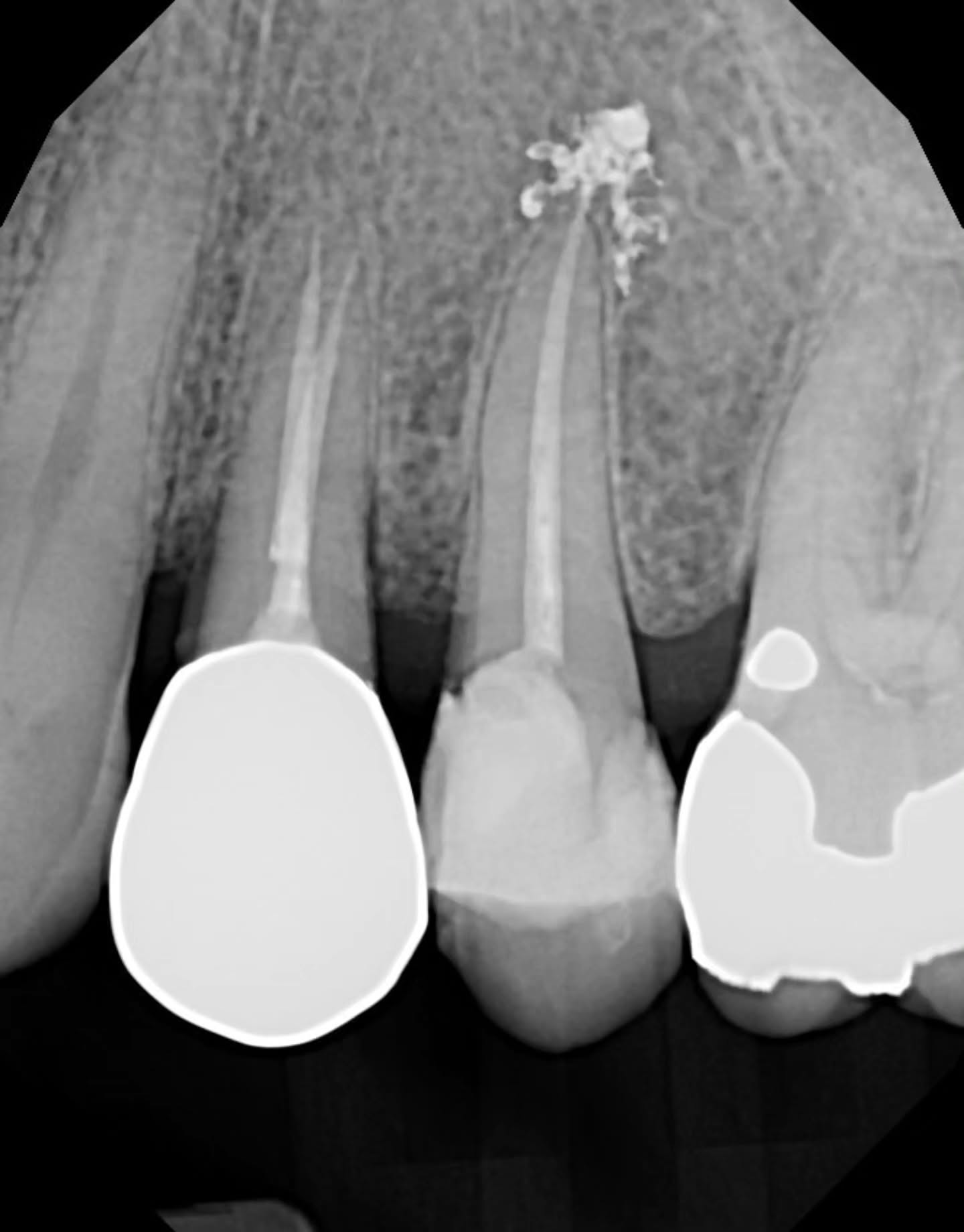25 RCT today — single canal, smooth shaping, and honestly everything went great… except the sealer puff that decided to show off on the PA.
I used Ribbon Root Canal Sealer @dentsplysirona.canada — the epoxy-amine resin one that mixes like butter and seals like a dream ✨️ Low shrinkage, self-adhesive, radiopaque — all the good stuff.
The fill looks dense, the patient’s comfortable… but that puff has me second-guessing how “perfect” perfect really needs to be.
Perhaps I slightly overinstrumented?
Some call it a badge of completeness — others call it a mild apical irritation waiting to happen. The literature’s split:
▪️ Martins 2023 found that controlled extrusion of epoxy resin sealer didn’t really affect healing outcomes (PMID 37516239).
▪️ Álvarez-Vásquez 2024 cautioned that freshly mixed epoxy-amines can be cytotoxic if they cross the apex (Dent Med Probl 61(2): 279–289).
▪️ And while Ferreira 2022 showed strong dentin adhesion with these sealers (PMCID PMC9689282), it’s that same flow and bond that sometimes lets them sneak past the finish line.
So yeah — clinically I’m happy, radiographically I’m… humbled.
What’s your take? A clean sealer puff with a resin sealer like Ribbon — harmless flex or something to rein in next time? Ideally a bioceramic sealer I imagine.
#Endodontics #ResinSealer #RibbonSealer #RCT #RootCanalTherapy #DentalCommunity