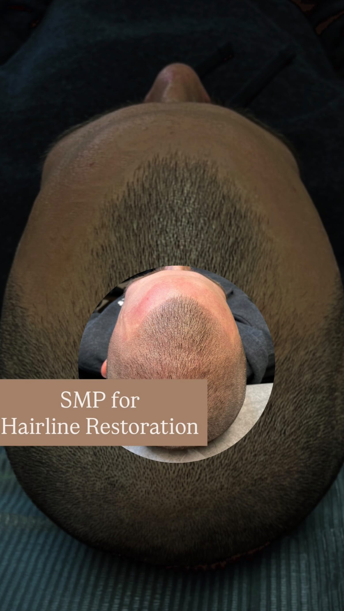 ✨SMP Hairline Restoration✨
Not just a new hairline..a new level of confidence.
At BLADED Inc, SMP Hairline Restoration delivers realistic density and definition that looks completely natural, even up close.
This advanced treatment recreates the look of real hair follicles for a clean, masculine hairline tailored to your features.
Serving Zionsville, Carmel, and Westfield, our SMP experts specialize in non-surgical hair restoration for men ready to reclaim a sharp, youthful look.
Tap the link in bio or comment/DM “RESTORE” to book your complimentary consultation.
#SMPforMen #HairlineRestoration #SMP #hairrestoration #ScalpMicropigmentation #zionsville #zionsvilleindiana #zionsvilledads #zionsvillehair #zionsvillebarber #carmeldadsclub #WestfieldIndiana #BladedInc #HairConfidence #MensGroomingIndiana
