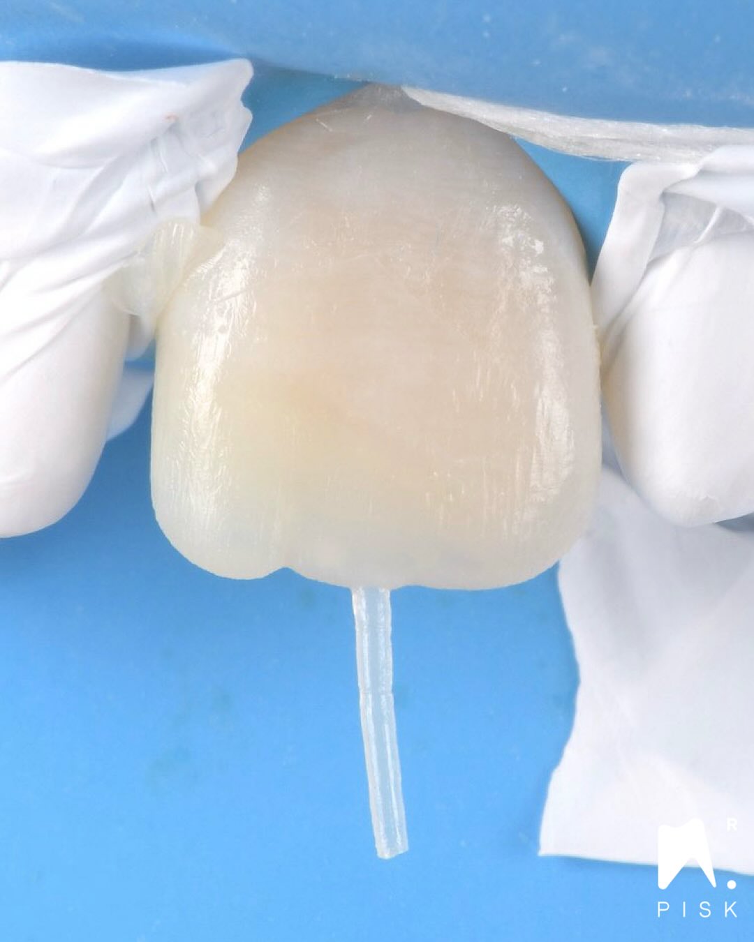 You want to learn more about this technique ? Go on « formation dentaire hdf »
https://formationdentairehdf.com/formations-au-centre/
New dates :
19/20 mars
18/19 juin
17/18 septembre
19/20 novembre
Material used :
- GUI,GC : JE, AE
- Gaenial achord : OA2, A2
- effects : pigment white, opalescent
🇫🇷
Même lorsqu’il s’agit d’une dent unitaire, la technique par stratification et injection reste indiquée.
Il est très simple de réaliser une clé transparente à partir du wax-up déjà existant.
Alors pourquoi se priver de la précision et de la reproductibilité offertes par l’injection ?
⸻
🇬🇧
Even for a single tooth, the stratification and injection technique is highly relevant.
Creating a transparent key from the existing wax-up is extremely simple.
So why not take advantage of the precision and reproducibility provided by injection?
⸻
#dentisterieesthétique #estheticdentistry #injectiontechnique #smiledesign #composite #GUI #gc #resincomposite #minimallyinvasive #drpisk