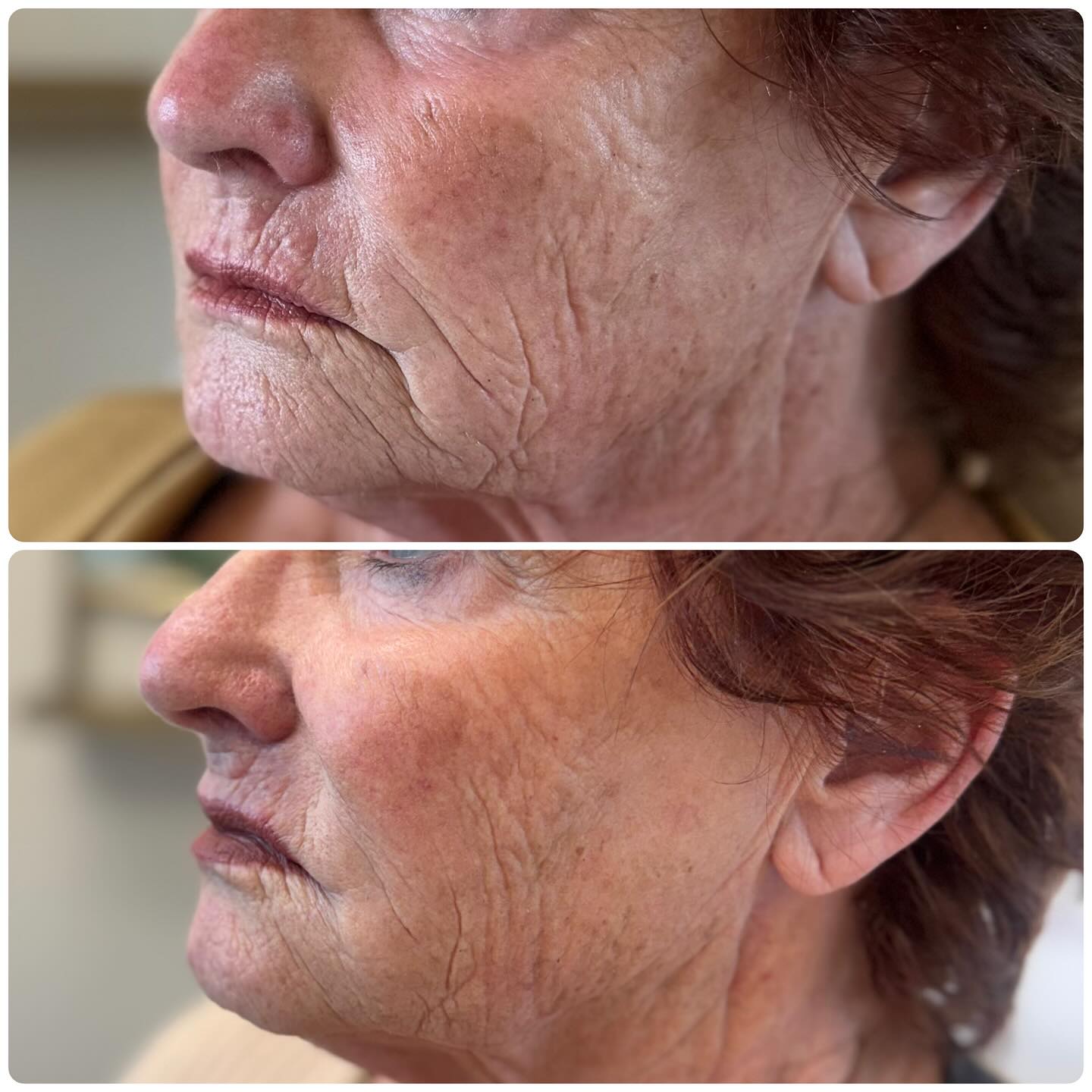 ✨ Subtle yet powerful rejuvenation ✨
Restoring harmony. Not changing faces 🩷.
We restored volume and softened deep lines to bring back her natural radiance : a look that feels authentic and beautifully aligned with how she feels inside.
Results will continue to improve and last 1–2 years. She’s absolutely thrilled & so am I! 🤍
.
#cloudnineclinic #juvederm #restylane #reclaiming #botoxcosmetic #botoxhighlandsranch #dysport