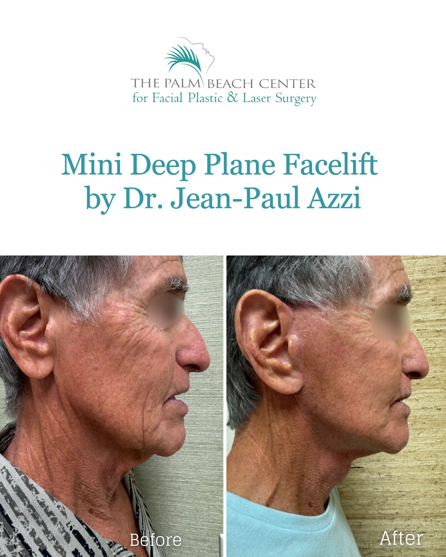 After photo is 3 weeks post-op. This patient wanted to look like himself — just more defined and youthful. After a mini deep-plane facelift with Dr. Jean-Paul Azzi, his jawline and neck look naturally younger without that “done” look.
That’s the beauty of Dr. Azzi's facelifts — friends just notice you look great, not different.
📍 Palm Beach Center for Facial Plastic & Laser Surgery
If you're ready to turn back the clock, schedule your consultation by calling us at (561) 429-5403 or request a consultation on our website (link in bio).
#minifacelift #drjeanpaulazzi #faceliftbeforeandafter #DeepPlaneFaceLift #DrAzzi #NeckLift #FaceLift #plasticsurgeryresults #facelifting #FacialPlasticSurgery #PlasticSurgeon #facialplasticsurgeon #JupiterFL #JupiterFlorida #PalmCity #PalmBeach #PalmBeachLife #westpalmbeachfl #ilovewpb #PalmBeachGardens #StuartFL #Tequesta #SouthFlorida #HobeSound #VeroBeach