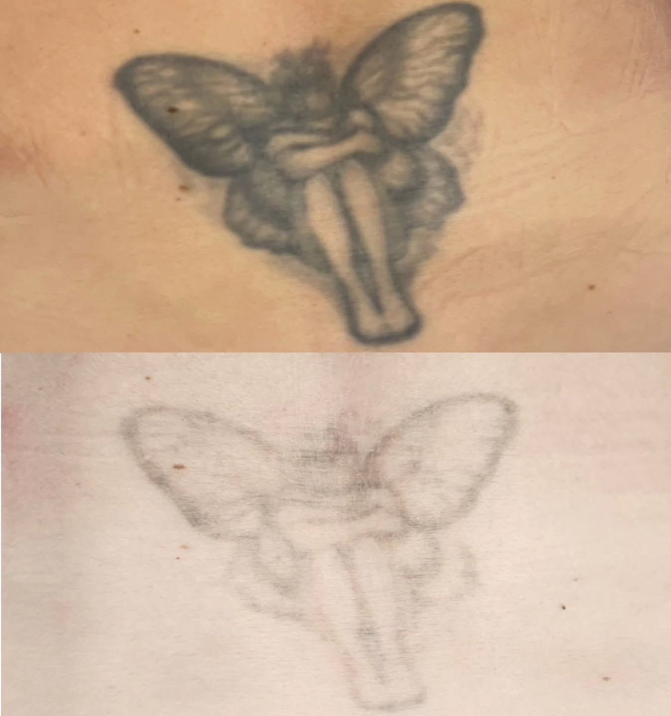 Only 2 sessions in and this fairy tattoo has already faded dramatically! PicoSure laser works gently yet powerfully to lift stubborn ink.