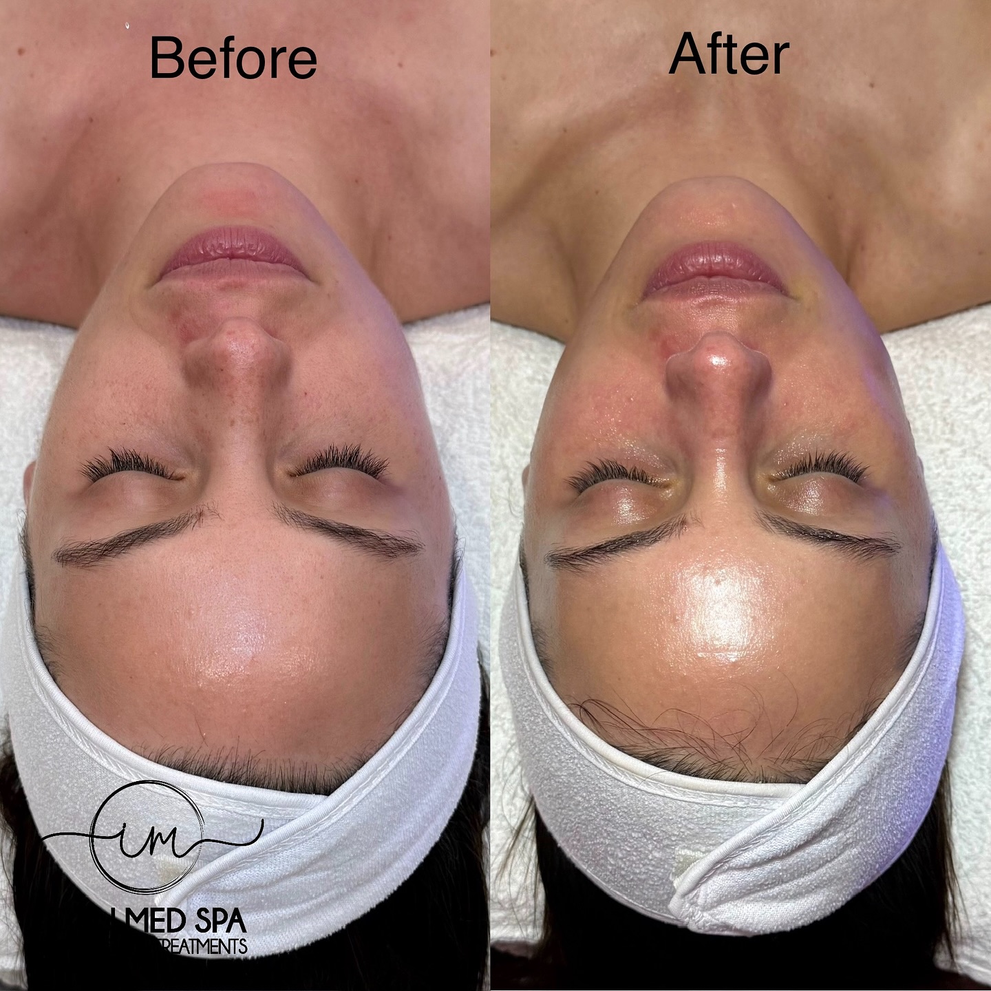 Dermaplaning Facial ✨
Smooth. Bright. Glowing.
This treatment gently removes dead skin + peach fuzz, leaving your face unbelievably soft and glassy.
Benefits:
• Makeup applies flawlessly
• Skincare absorbs better
• Instantly brighter complexion
• No downtime
• Safe for most skin types
Glow is one facial away ✨
Book your Dermaplaning today 💗