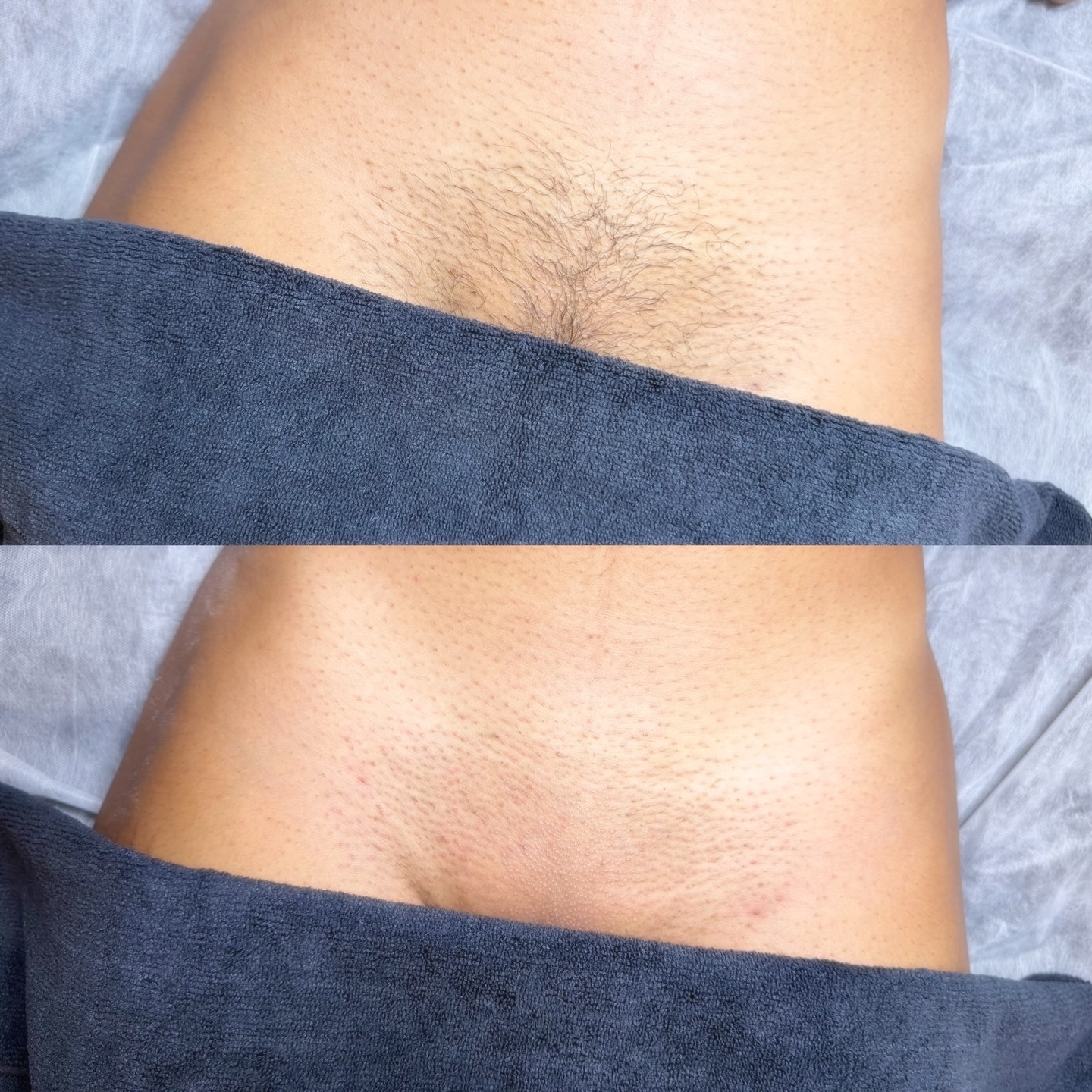 Still shaving?! 🪒The top photo is 5 weeks of growth!! This client is consistent with her waxes which is 🔑 when it comes to waxing ☺️ As a wax specialist with 10 years experience, there’s no one better to trust with your most delicate area 🌸 Check out my first time specials and start your waxing journey with Bare Beauty Co. ✨
#waxing #brazilianwax #brazilianwaxwesleychapel