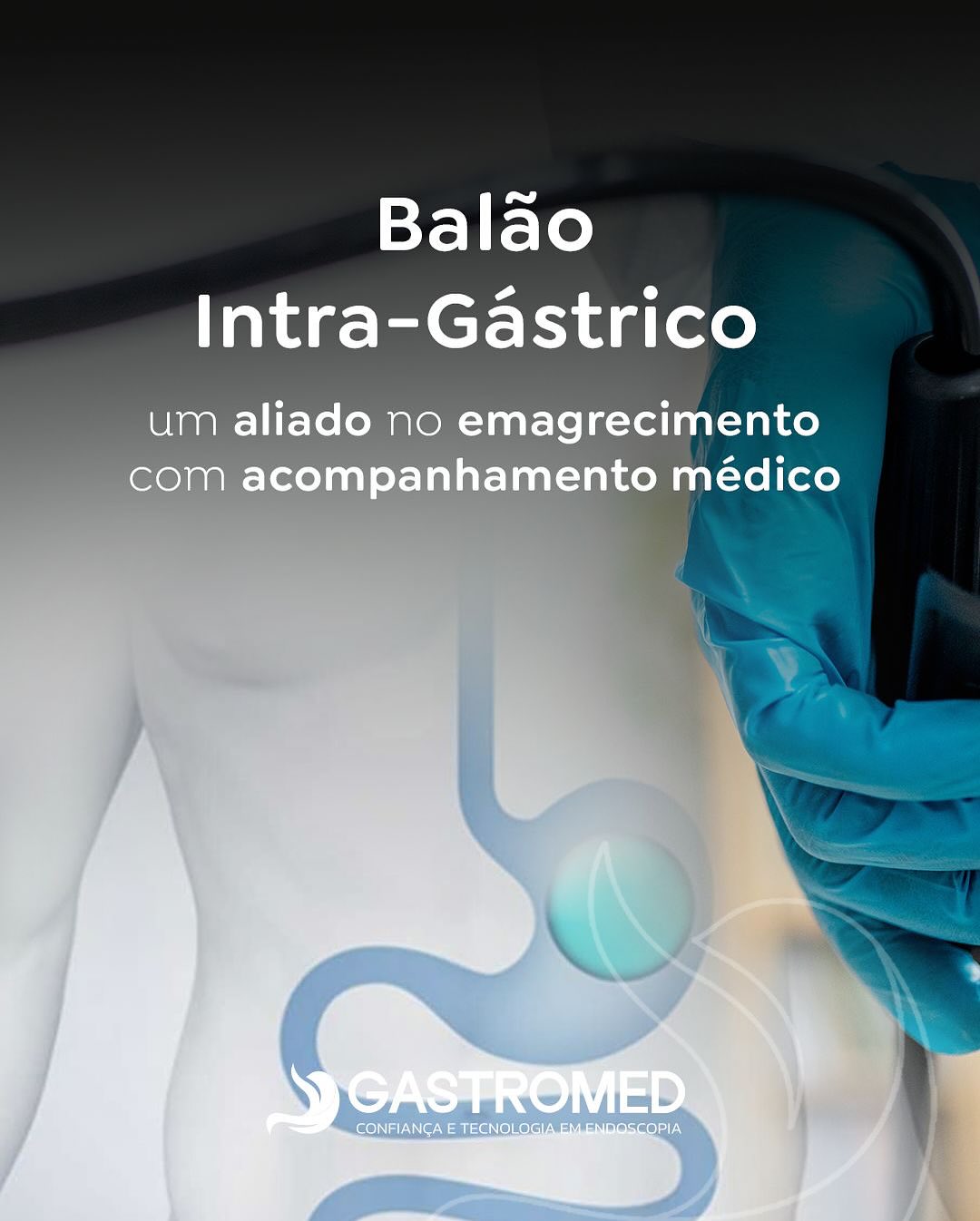 O Balão Intra-Gástrico é um tratamento endoscópico que auxilia na perda de peso de forma segura, temporária e sem cirurgia.
Inserido por endoscopia, o balão é preenchido com soro e permanece no estômago por um período determinado, promovendo saciedade e controle da ingestão alimentar.
Com o acompanhamento médico e nutricional adequado, o procedimento contribui para resultados consistentes e sustentáveis, além de melhorar condições associadas ao excesso de peso.
💙 Na Gastromed Erechim, o Balão Intra-Gástrico é realizado com equipamentos modernos, equipe experiente e foco na saúde integral do paciente.
#GastromedErechim #BalãoIntragástrico #EmagrecimentoSaudável #EndoscopiaTerapêutica #SaúdeDigestiva #gastroenterologia