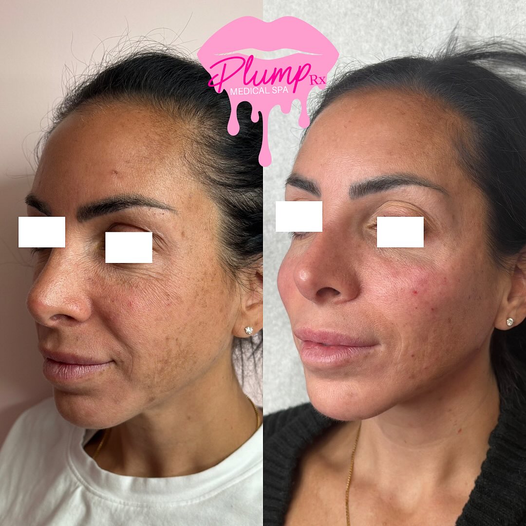 Facial balancing magic โจ
By enhancing the cheeks, chin, and jawline, we created symmetry and lift. The improvement in her smile lines says it all ๐ Natural, soft, and beautifully refreshed!
๐๐๐๐๐ ๐๐ ๐๐๐๐๐๐๐ ๐๐๐
๐ Reading, Ma
๐ฝ๐ ๐ฃ ๐ธ๐ก๐ก๐ ๐๐๐ฅ๐๐๐๐ฅ:
๐ฒ BOOK NOW: Plumprxmedspa.com
๐๐๐ฅ๐ฎ๐ฆ๐ฉ๐ซ๐ฑ@๐ ๐ฆ๐๐ข๐ฅ.๐๐จ๐ฆ
๐ฒ๐ 781-521-0236