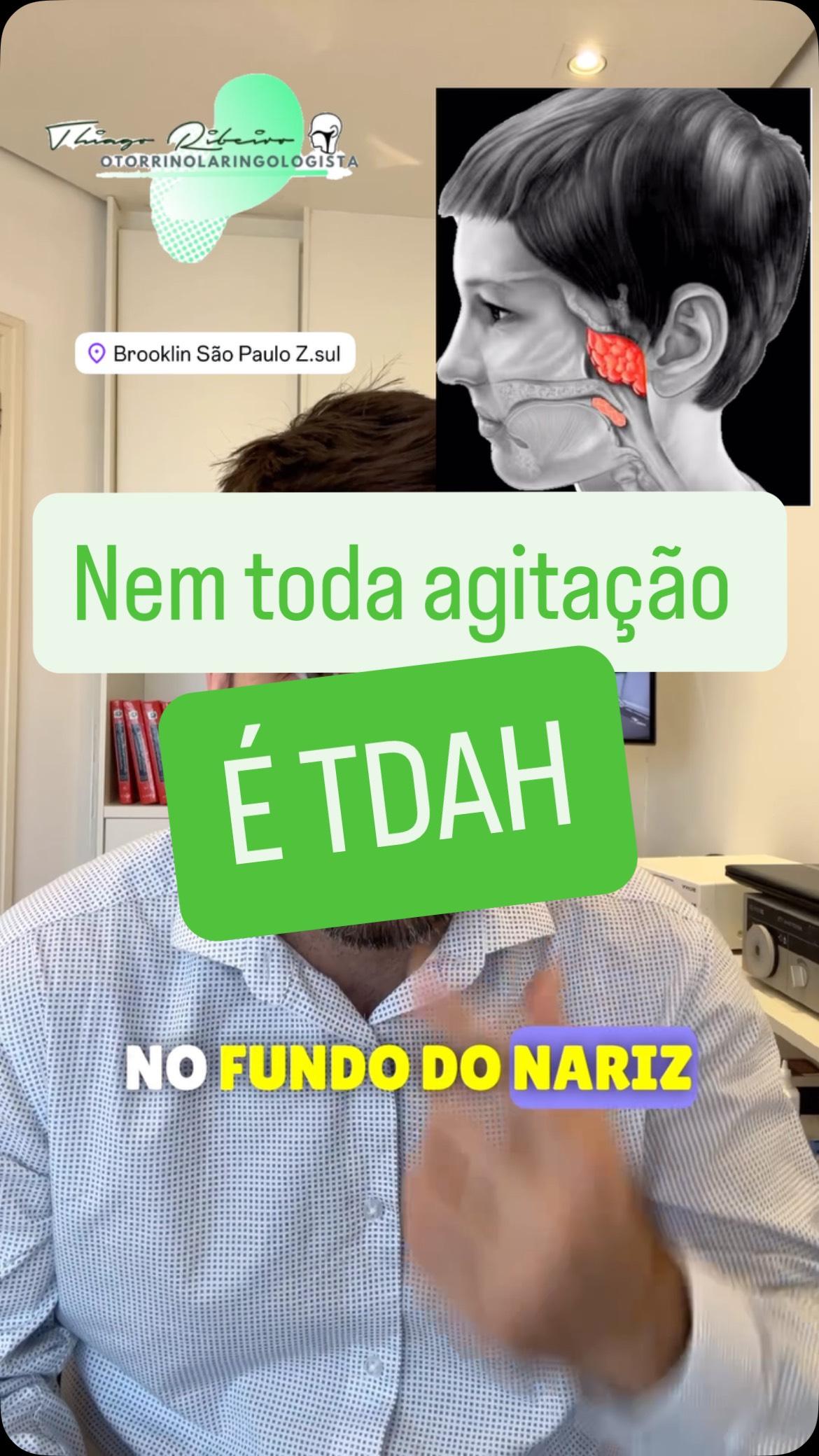 “Seu filho vive agitado, irritado ou com dificuldade pra se concentrar? 👀
Nem sempre é TDAH… às vezes, o problema está nas amígdalas e adenoide !”
Meu nome é Thiago Ribeiro de Almeida, otorrinolaringologista aqui de São Paulo !
⸻
“A hipertrofia das amígdalas palatinas — aquelas ‘bolinhas’ no fundo da garganta e adenoide — pode dificultar a respiração, principalmente à noite.
Isso faz a criança dormir mal, roncar e até ter pequenas pausas na respiração.”
“E o resultado? Um sono ruim, nunca chega no sono profundo N3( principal fase da produção hormonal) e controle do cortisol que deixa o cérebro cansado aumentando o nível de stress
Durante o dia, a criança fica agitada, irritada e com dificuldade pra prestar atenção.”
“Se você percebe esses sinais, vale procurar um otorrino para avaliação.
“Nem toda agitação é TDAH… às vezes, é só falta de oxigenação adequada durante o sono e excesso de cortisol ! 😴💨
Compartilhe com outros pais que precisam saber disso ! #drthiagoribeirodealmeida #nariz #sinusectomia #brooklin