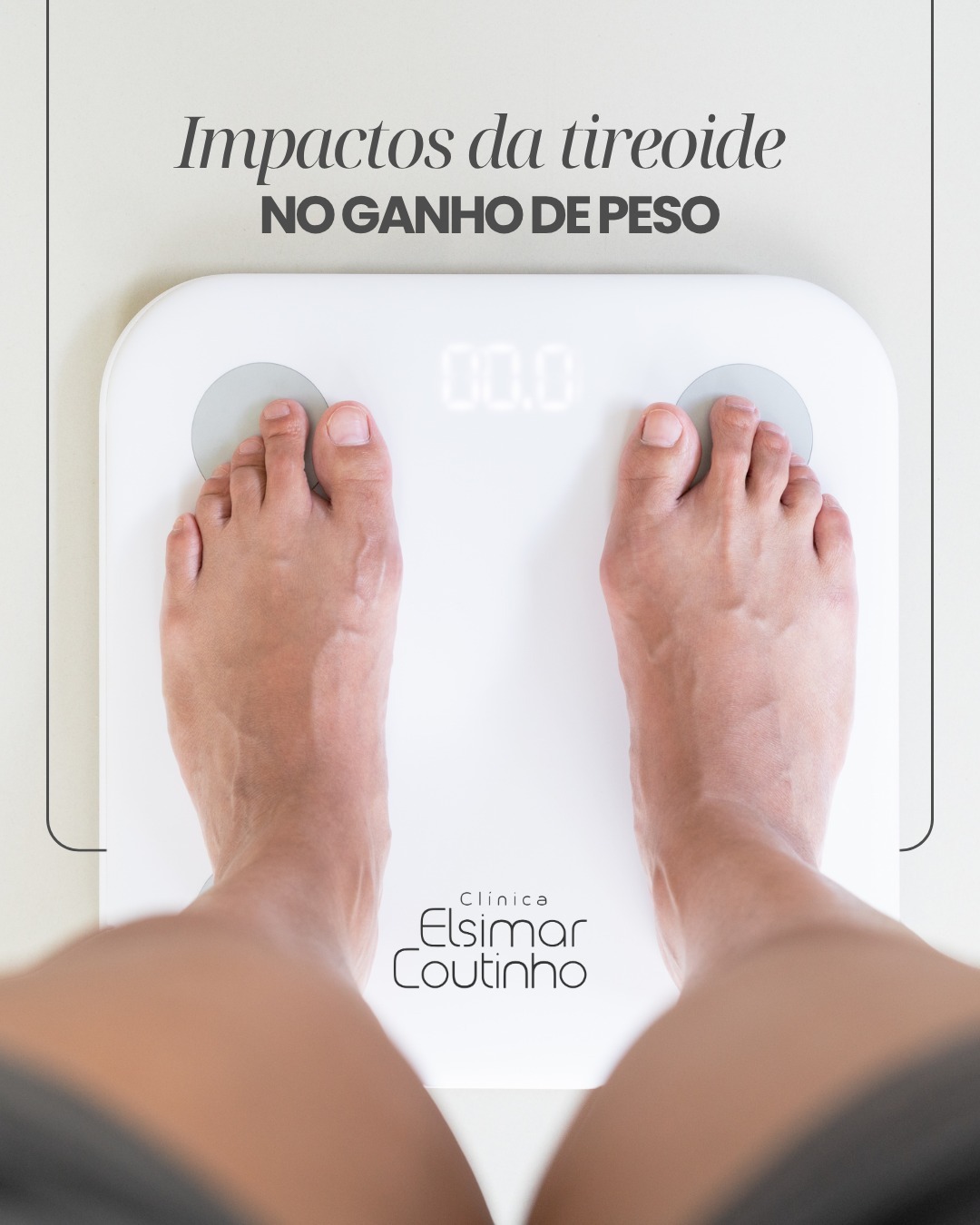 Mesmo com dieta e exercícios, o paciente pode ter dificuldade em perder ou o ganho de peso sem explicação, e a tireoide desregulada, pode ser a causa.
Não é "falta de força de vontade", é uma questão de metabolismo!
Quando a tireoide produz hormônios de forma insuficiente, condição conhecida como Hipotireoidismo, todo o seu corpo desacelera. Isso inclui o seu metabolismo!
A energia que o corpo gasta em repouso diminui, o corpo queima menos calorias, o que facilita o acúmulo de peso e dificulta a perda.
Grande parte do ganho de peso inicial no Hipotireoidismo é devido à retenção de líquidos e sal, e não apenas ao acúmulo de gordura.
Não adianta tentar dietas restritivas sem antes resolver a desregulação hormonal.
Agende sua consulta com a nossa especialista, e vamos cuidar do seu metabolismo.
#TireoideEPeso #GanhoDePeso #Hipotireoidismo #MetabolismoLento #ClínicaElsimarCoutinho
Agendamento 📲 4007-2947
📍Av. Moema, 300, 13º andar, Moema - São Paulo