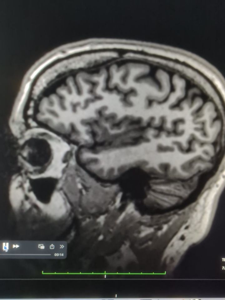 So I made an anatomically accurate 3D model of my cerebral cortical surface, conveying the exact size and shape of my brain as it sits in my head. I frequently have to jump in the MRI scanner to test research protocols, so I started with a pretty standard high-resolution scan of my brain.
1. These are the T1-weighted images I started with, for those who might care about the pulse sequence.
2. I took the 208 separate sagittal slices and essentially sewed them together digitally into a block (head), then created a smooth surface rendering of the entire image. Note the noisy parts with signal dropout.
3. Next, I added more smoothing and more detailed contouring by creating a volume rendering. Here, you'll see the chunk of image around the mouth that is lost because of susceptibility artifacts (chiefly) near those regions of the face. You'll also see how terrifying my real demon appearance is.
4. Then, I digitally stripped away all layers of my skin, my eyes, my nose, ears, the underlying fat, the skull, and the thick layers of dura and meninges that wrap the brain. Then chopped off the neck, spinal cord, and cerebellum at the base of the brain, removing everything to reveal the cerebrum!
5. Zooming in on the digital surface model, you can see all the tiny triangles that are used in the tesselation to accurately represent the cortical surface in three dimensions. There are about 300,000 triangles per hemisphere required.
6, 7, & 8. Lastly, I 3D-printed the final surface rendering in exactly the real-life total size and proportions of my brain. I'm really impressed with how smooth and accurate the printing came out!
Also, some new music (under construction) is playing in the background.
I hope everyone is doing well! 🧠🫀🎶
#mri #cerebralcortex #3dprintedmodel