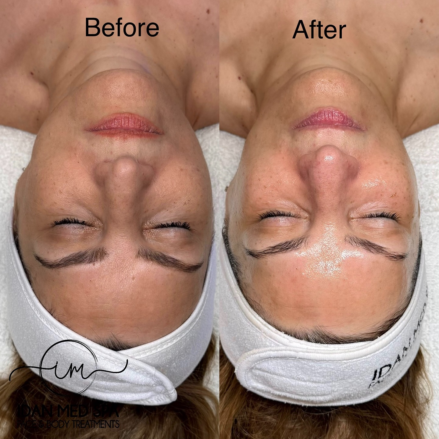 Salmon DNA Facial – Real Results!
Our Salmon DNA Facial boosts collagen, brightens dull skin, reduces fine lines, and leaves your skin glowing from within.
💧 Results after just ONE treatment
💎 Boosts elasticity & hydration
🌟 Improves texture and overall radiance
Ready for your glow?
📍 SF & LA Locations
📲 Book now: @idanmedspa
#idanmedspa #salmonDNAfacial #beforeandafter #glowingskin #skintightening #skinrenewal #facialtreatment #skincareclinic #skincareexperts #antiagingfacial #collagenboost #hydrafacialalternative #glassskin #skingoals #losangelesspa #sanfranciscospas #beautyresults #skinsmoothening #skincaretransformation