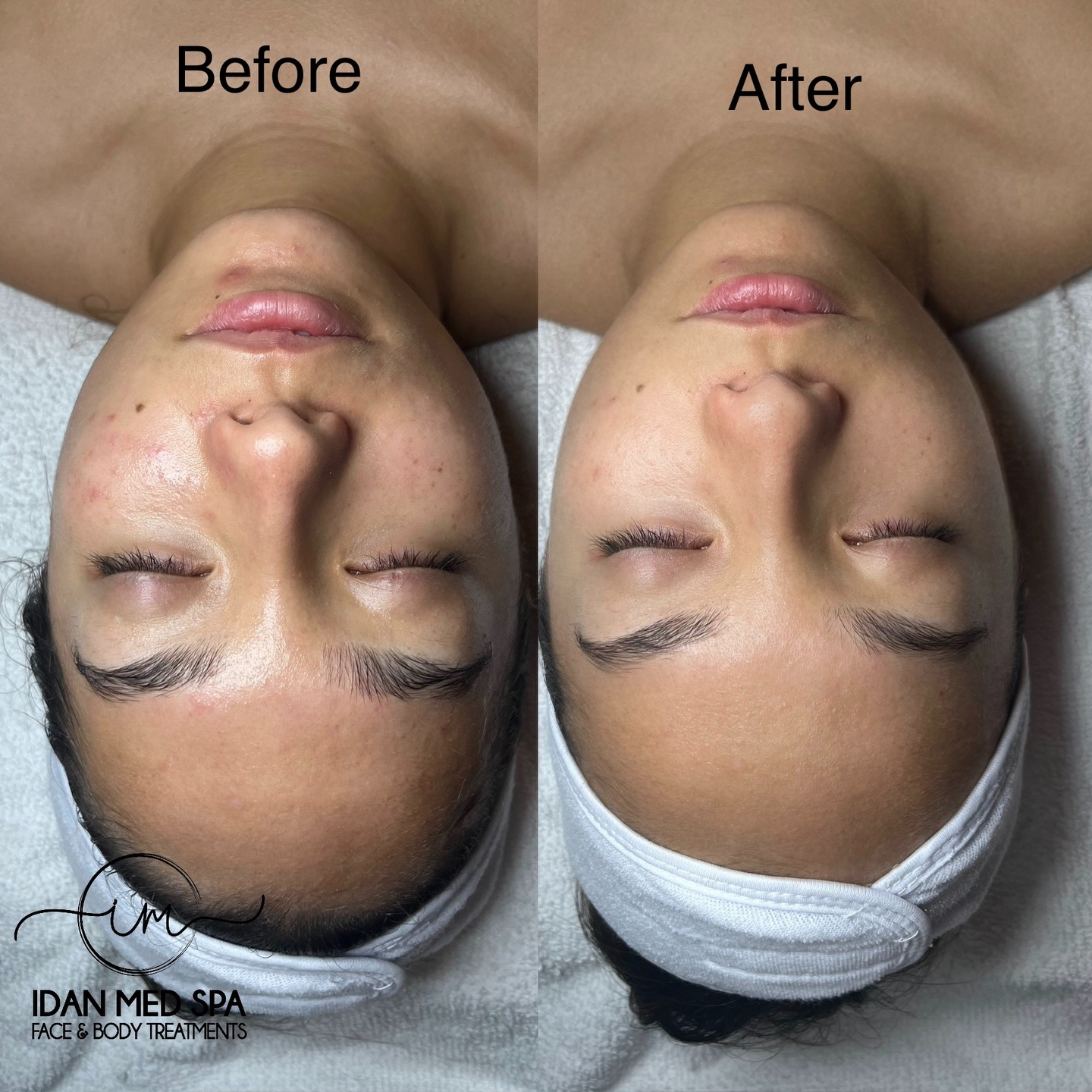 Salmon DNA Facial at Idan Med Spa
Now available in San Francisco & Encino
Boost your glow with one of the most advanced skin-rejuvenation treatments in the industry. Our Salmon DNA Facial helps improve:
✔️ Fine lines & wrinkles
✔️ Redness and inflammation
✔️ Dull, dehydrated skin
✔️ Overall texture and elasticity
Expect brighter, smoother, firmer skin — naturally.
Your glow starts here ✨
📍 Encino – 17217 Ventura Blvd
📍 San Francisco – 3520 20th St
📞 Book now: 818-661-2512 / 628-222-7522
#SalmonDNA #IdanMedSpa #EncinoMedSpa #SanFranciscoMedSpa #SkinRejuvenation #GlowUp #FacialTreatment #SkincareExperts