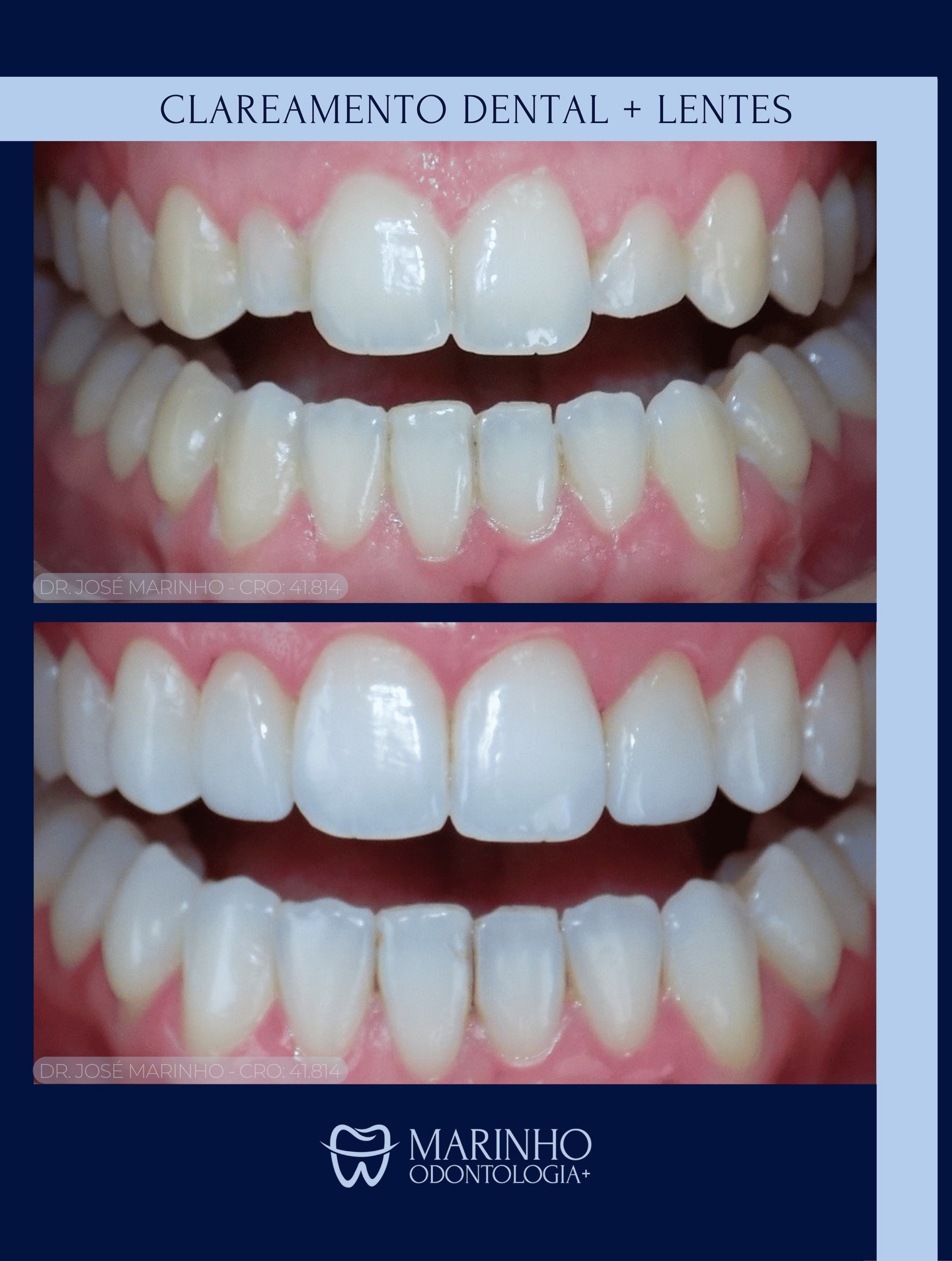 Nem sempre o melhor resultado exige muito. Recebemos muitos pacientes buscando instalar lentes em todos os dentes, mas com um planejamento especializado encontramos alternativas muito mais conservadoras.
Aqui, apenas 2 lentes e um clareamento foram suficientes para transformar o sorriso de maneira natural e minimamente invasiva.
Nossa filosofia é clara: resultado estético e funcional, com o mínimo de intervenções possível!
#dentista #dentistamoema #dentistamoemasp #saudebucal #moema