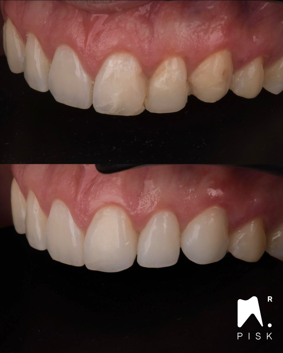 🇫🇷
Cas de fracture ancienne sur 21-22-23.
Le patient avait conservé son ancien modèle en plâtre : un véritable trésor !
Nous avons pu l’utiliser comme base pour reproduire à l’identique les formes initiales.
Les restaurations ont été réalisées en composite stratifié injecté, combinant précision et esthétique naturelle.
Résultat : un sourire retrouvé, fidèle à l’original.
🇬🇧
Fracture case involving teeth 21-22-23.
The patient had kept his old plaster model — a real treasure!
We used it as a reference to recreate the exact same tooth shapes.
The restorations were made using layered and injected composite, achieving both precision and natural esthetics.
Result: a restored smile, true to its original design.
#DentisterieEsthétique #CompositeInjecté #RestaurationsDirectes #SmileDesign #EstheticDentistry #InjectedComposite #DrPisk #Lille #France #DentalArt