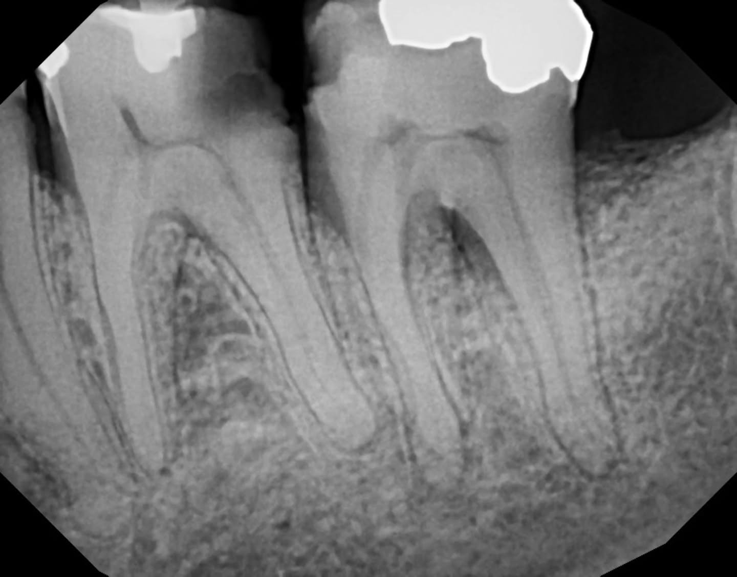 I really thought I could cut down my file-fracture rate by being extra disciplined with my glide path + always flaring the coronal third with an @dentsplysirona.canada SX.
It does help:
- better irrigation
- easier Ca(OH)₂ placement
- smoother shaping
fewer surprises…
Well… until this case. 😅
Because in this recent case an SX BROKE in a 36 distal canal.
So yes… we had a little complication.
Took two PAs (straight + mesial angle).
Applied the classic SLOB rule:
Same = lingual
Opposite = buccal
→ Fragment was distal, so likely DB.
I couldn’t even see the fragment clinically, so I:
tried to bypass (and honestly, I think I actually did)
irrigated like my life depended on it
ultrasonics + activator
literally every trick in the book
At one point I grabbed the intraoral camera and my assistant pointed at a speck and said “there!”.. I was like: “That’s MESIAL. Why would it go THERE now :(((("
At that moment I accepted defeat, planned to place Ultracal + temporize, took a final PA and…
the fragment was GONE.
Just. Not. There.
No shadow, no metal, no nada.
I will never know when it flushed out but honestly?
I’ll take the win. 😂
Endodontics keeps you humble.