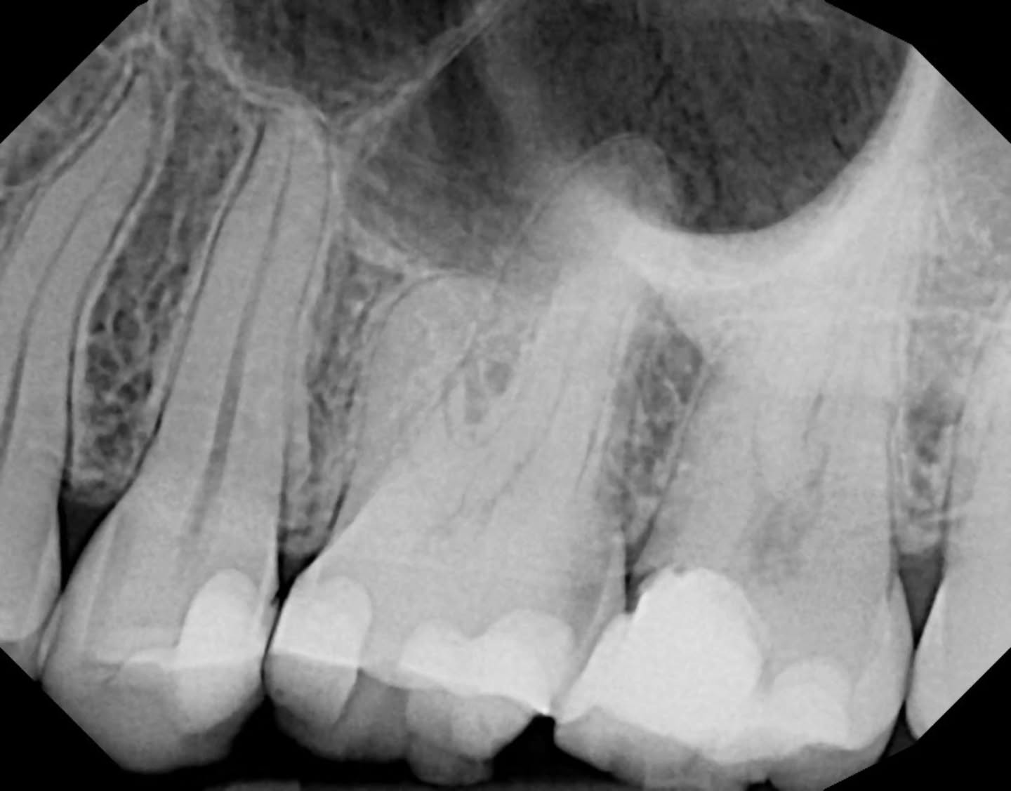 This #27 actually kept me up the night before the appointment. Limited access, an anxious patient, and an upper second molar with anatomy that I knew was going to test every bit of finesse I had.
Tight canals, tricky orientation — honestly, God bless the ProTaper SX for helping open offices I could barely visualize. I spent a long time searching for an MB2, and I’m confident it wasn’t present here. And while CBCT is always helpful, thoughtful molar endo can still be performed safely and predictably with careful tactile sense and sound judgment.
Despite the mental load (and my brain running every possible “what if” scenario at 3 a.m.), the appointment itself was calm, deliberate, and very satisfying. There is always room to refine technique, but I’m genuinely proud of the process, the execution, and the growth.
And I’m grateful to my patient, who pushed through a very challenging appointment with patience and trust.
Molar endo is a different beast — and I really do love it. 🦷✨
And honestly? Every time I see associate ads that say “must be comfortable with molar endo,” I feel a tiny spark of pride now. Still lots to learn — as always — but at least I can finally say: okay… maybe I can apply to those now 😂.