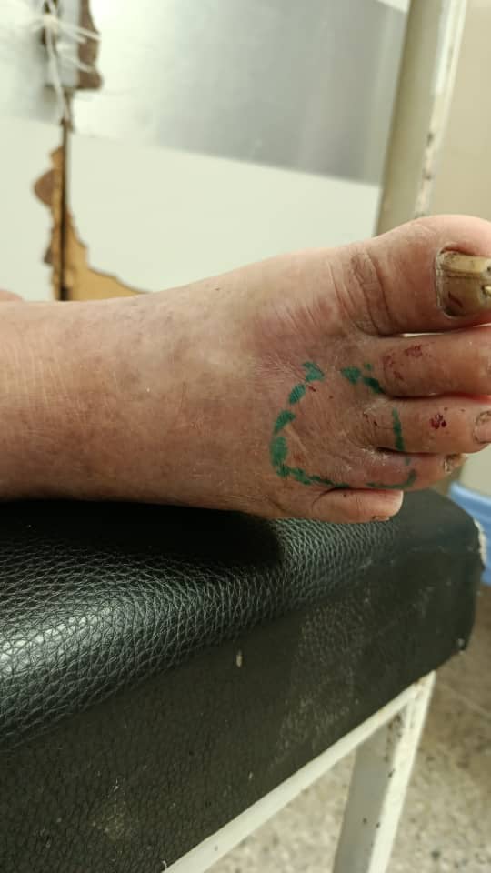 🚨 Caso de emergencia en adulto mayor — Mordedura de Bothrops (mapanare)
El señor Pascual, de 78 años, fue mordido a primera hora de la mañana y llegó al Hospital Central de San Cristóbal después de casi 10 horas sin antiveneno, lo que aumenta significativamente el riesgo de complicaciones.
Presenta dolor intenso, edema en expansión y un cuadro compatible con envenenamiento moderado que requiere infusión continua de antiveneno y monitoreo estricto. Nuestro equipo está brindando acompañamiento a la familia y asesoría médica al personal tratante.
El hospital necesita apoyo urgente para cubrir exámenes de laboratorio esenciales (coagulación, función renal, hemograma). Estos estudios son determinantes para ajustar el tratamiento y proteger su vida.
🙏 Necesitamos de tu ayuda.
Cualquier aporte suma y puede marcar la diferencia para el señor Pascual y su familia.
DONA o Comparte esta Publicación.
BANCAMIGA
CTA. CORRIENTE: 0172-0201-49-2015105170
CTA. DIVISA: 0172-0201-40-2015099894
PAGO MOVIL: J-502156399/0424-408.5311