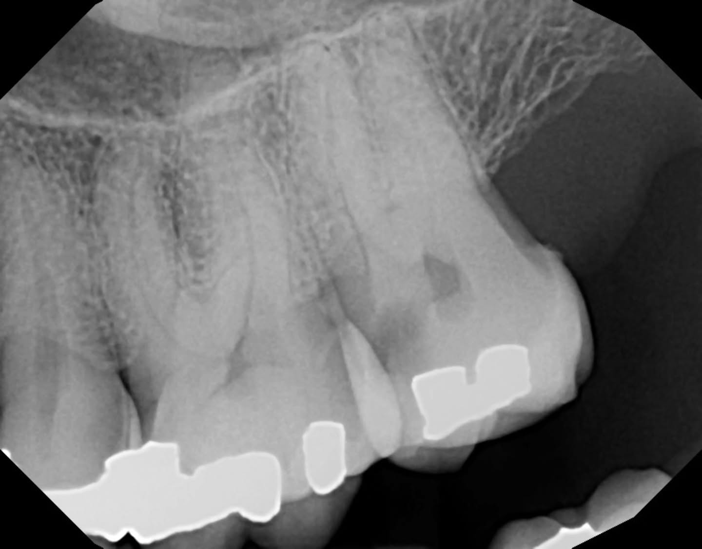 27n is my favorite rubber dam clamp for upper molars.. never fails me 💕 i believe it is actually a premolar clamp but u love who u love.. 27n is perfect for me 2nd molars... try it next time
جرب ودعيلي 😆✨️