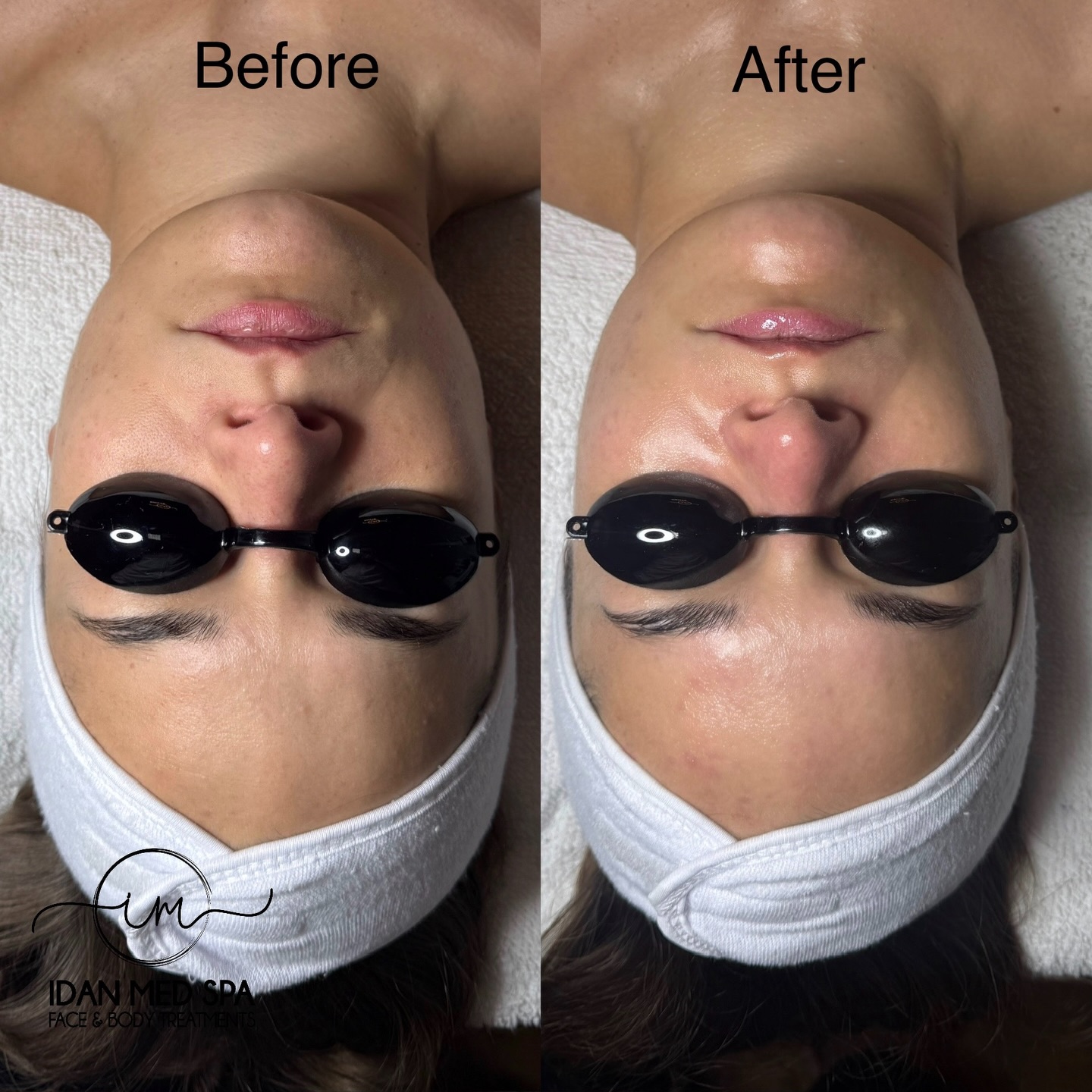 Your skin’s favorite drink
Our Hydro Facial deeply cleanses, hydrates, and leaves you with an instant glow
📍 Encino: 17217 Ventura Blvd, Encino, CA
📞 (818) 661-2512
📍 San Francisco: 3520 20th St, SF, CA
📞 (628) 222-7522
Book your glow session today
#IdanMedSpa #HydroFacial Encino SanFrancisco LAesthetics SFSkincare GlowingSkin HydratedSkin #SkinGoalas