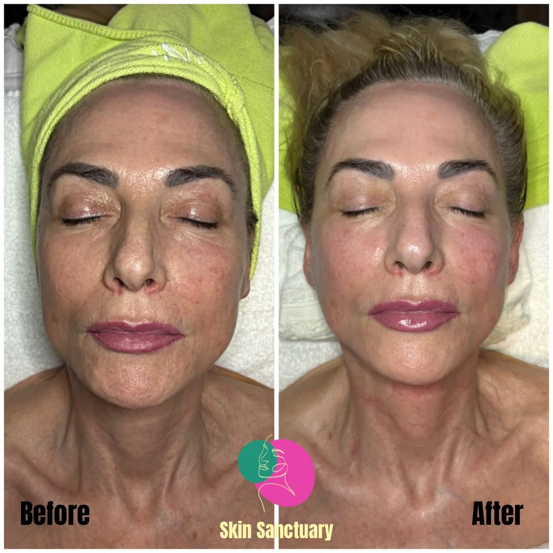There’s a reason your skin still isn’t improving…
If your skin has been feeling inflamed, sluggish, textured, sensitive, or like it’s just not cooperating… here’s the truth:
✨ Your skin is constantly communicating with you.
✨ It’s designed to repair, renew, and restore ITSELF!
✨ It needs support that works WITH its natural intelligence.
This is where DMK Enzyme Therapy comes in.
DMK Enzyme Therapy rebuilds and re-educates the skins natural function on a cellular level.
During a DMK Enzyme treatment, your skin experiences:
🌿 Increased oxygenation and nutrient flow
🌿 Elevated lymphatic movement for natural detox
🌿 Strengthened collagen + elastin networks
🌿 Improved cellular communication
🌿 A healthier, more resilient barrier
🌿 Rebalanced internal chemistry
🌿 A surge of circulation that brings your skin to life!
When the skin is supported, it responds. Which then allows it to transform!
🧖🏼♀️ Ready to see the lasting results you’ve been wanting?
Send me a DM with “ENZYME” or tap the link in my bio to book your treatment.