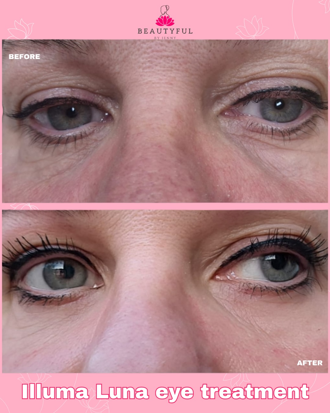 What did I get done to achieve this before and after?
👉🏻Illuma Luna eye treatment
👉🏻 Polynucleotides
👉🏻3 Peptides
👉🏻 Hyaluronic acid
If you saw my last video, you’ll know how easy it is to apply these plus results can be seen immediately! This is the before and after on the same day, that I did on myself this week
It’s such a wonderful Christmas present for anybody who is conscious of their eye area - or who was looking to get glowy radiant skin without the downtime
Contact me to book in for yourself or a loved one this Christmas 🎄
also available in a voucher!