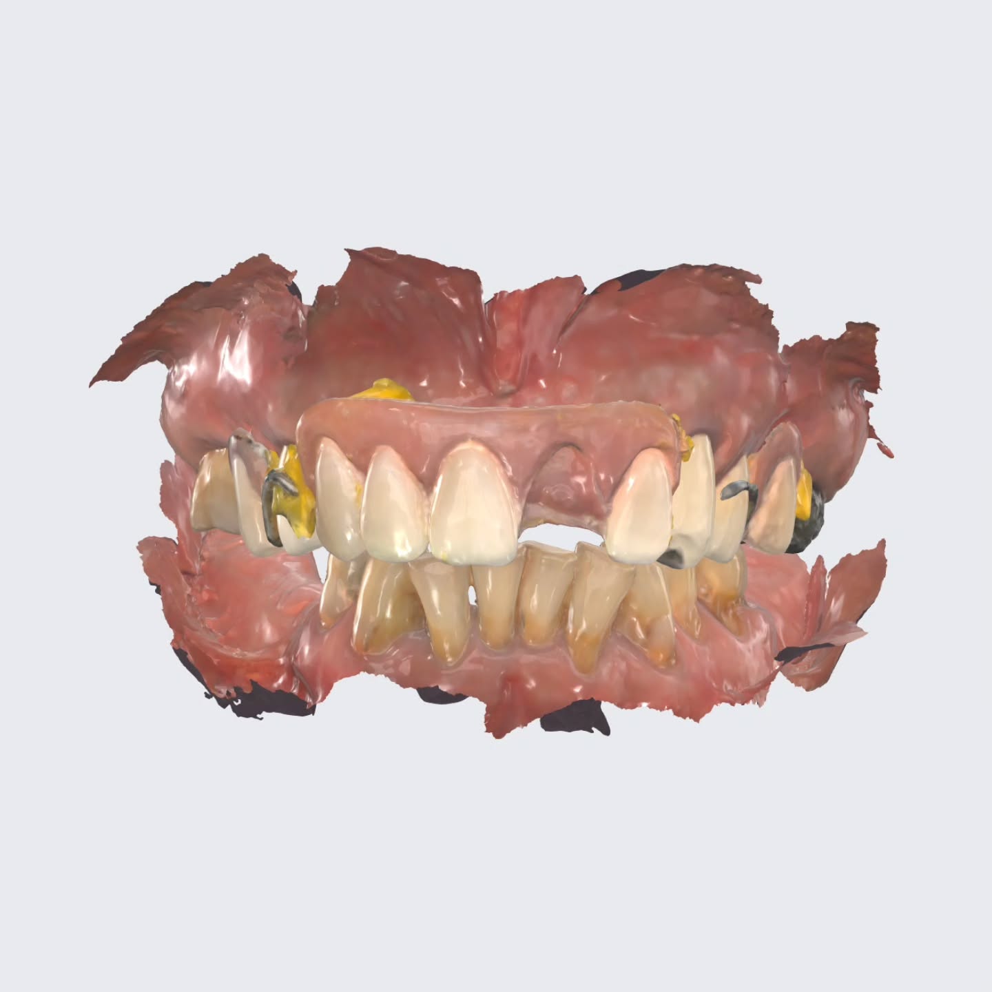 Welcome to my new series that I’m trying to work on called “What the f* do I do when I get stuck in dentistry?” 😰😫😱
Did you know you can scan everything you can think of with your Medit i700??? @meditcompany @medit.na
Did you????
I didn’t think so. 🤭
Let me tell you — OMG — hear me out.
In this fully de-identified digital workflow example, the goal was to upgrade an acrylic partial to a cast partial. The aesthetics of the existing denture teeth were working well, so I wanted to scan that information for the lab. I also needed to capture the bite. AND I wanted to scan the older cast partial because its design actually worked better than a newer version that didn’t extend all the way to the back of the palate..
When the palatal strap sits too far anteriorly, food gets trapped in the roof of the mouth. When it extends more posteriorly, food doesn’t collect. So I wanted to capture the exact palatal strap placement from the really old cast partial.
BUT my Medit was NOT doing that cute song on the acrylic partial. 🫠
It wouldn’t recognize it.
It wouldn’t mount it.
It said: “No <3.”
LIGHT. BULB. 💡✨️
If you ever get stuck here… take a breath… grab some light-body PVS and do almost like a pickup impression (if that’s even the right term). Do a light body wash inside the denture — that’s the yellow in the photos.
NOW the scanner can pin the scans together — as long as each part is scanned in the correct stage within Medit’s Stage Management workflow, AND there’s enough overlapping geometry for the software to recognize what goes where.
It worked right away. 😎
The minute I did that, the software got a WAY better bite and I was able to get all the information I needed.
Also: don’t forget CAD/CAM spray when scanning shiny metal like the old cast partial.
Digital dentistry is half science, half chaos, half problem-solving.
Yes, that’s three halves.
Welcome to my brain.
