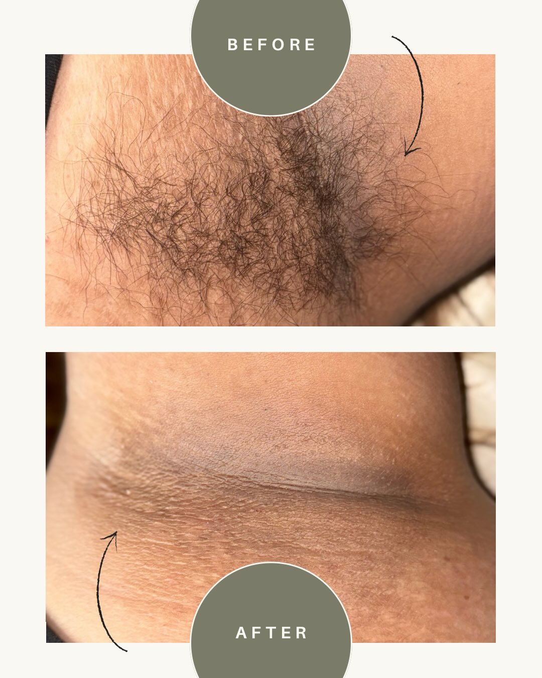 Under Arm Wax ๐ฏ
๐๐ฎ๐ฏ