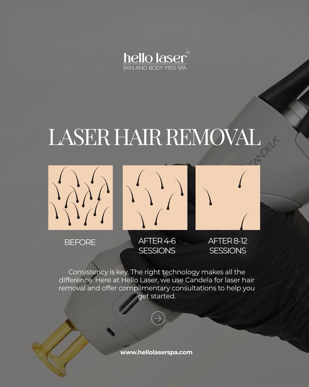 Thinking about laser hair removal? 🤔 Here are some common questions we get:
•Does it hurt?
Most clients describe a mild snapping sensation, manageable and brief.
•How many sessions will I need?
Typically 6 to 8 sessions spaced 4 to 6 weeks apart, depending on the area and hair type.
•Can it be done on all skin types?
Yes. Our Candela lasers are safe and effective for a wide range of skin tones, from Fitzpatrick Type I to VI. Yag and Alex lasers allow us to customize treatment for every skin type.
•How long do results last?
Results are long-lasting, especially with consistent treatments, though maintenance may be needed over time.
With over 20 years of experience in the medspa industry, Hello Laser is a trusted choice. We use Candela, the gold standard in laser hair removal, to deliver safe and effective results.
💻 Schedule your consultation and get personalized answers at www.hellolaserspa.com
Consistency is key, let’s get you smooth for good!⚡️