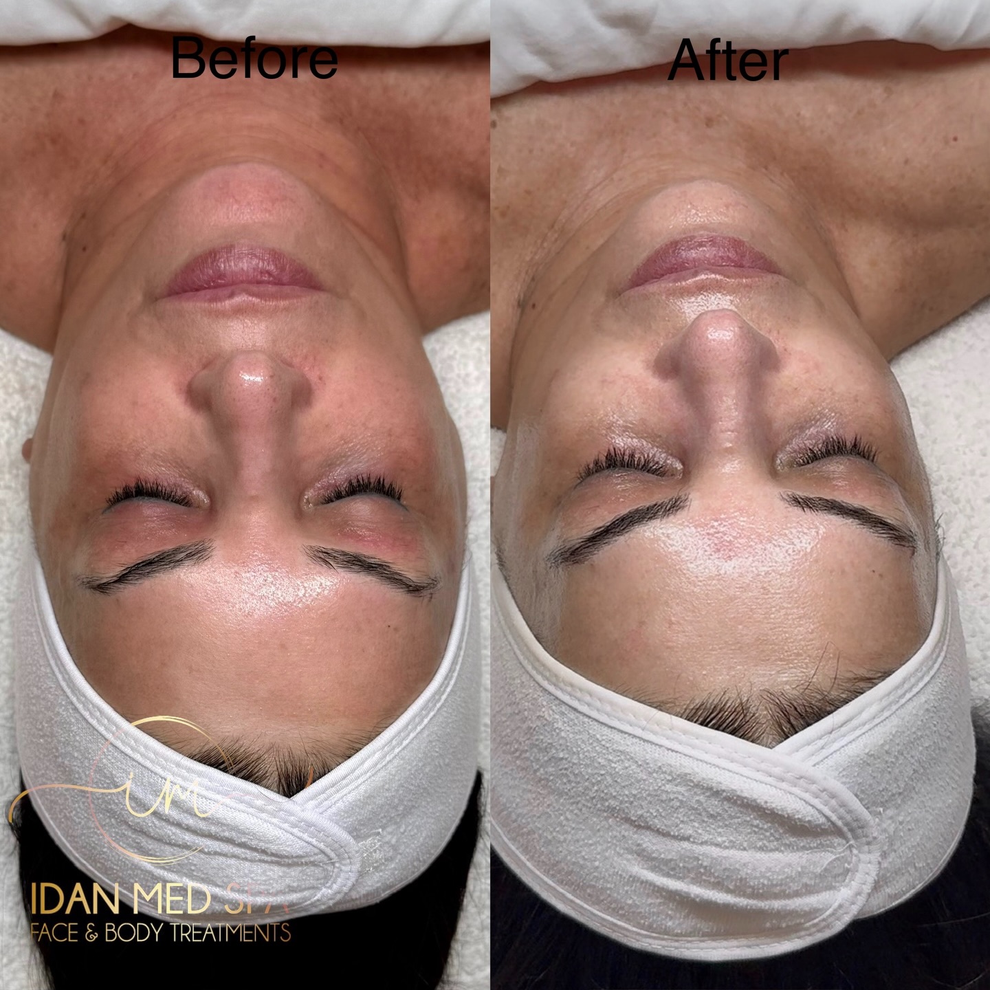 Our Salmon DNA Facial is designed to deeply hydrate, repair, and improve skin elasticity for a smoother, firmer, and more radiant complexion.
Needle-free. No downtime. Real results.
Encino | San Francisco
#SalmonDNAFacial #BeforeAndAfter #IdanMedSpa SkinRejuvenation AntiAgingFacial GlowingSkin FacialResults LuxuryFacial EncinoMedSpa SanFranciscoMedSpa