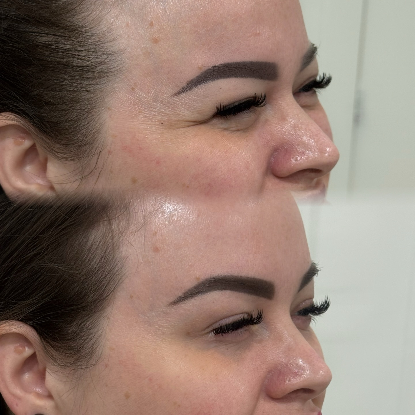 Treatment: Brow Lift & Crow’s Feet Treatment using Tox
In the before photo, you can see that her eyebrow sits lower, creating a heavier upper eyelid with limited lid show. The downward pull also contributes to visible crow’s feet when she smiles.
In the after photo, the eyebrow has a subtle lift with a more refined arch. The eyelid is more visible, giving the eyes a brighter, more open appearance. Crow’s feet are softened, and the overall eye area looks smoother and more lifted while still natural.
For more information or to book a consultation, contact us:
📱 343-451-7141
✉️ infoshaybloo@gmail.com
#ottawa #nurseinjectorottawa #lips