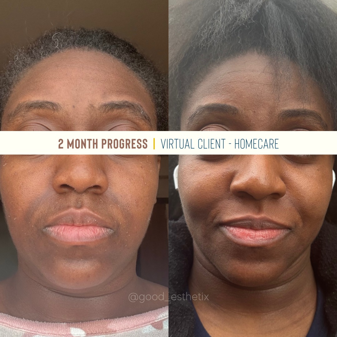 Another beautiful skin transformation ✨
When this client began working with me, her skin was imbalanced.
Together we simplified her routine - with barrier repair as our primary goal. We focused on deep hydration and protection, which allowed the skin to rebuild on it's own — and the results speak for themselves.
Consistency was the most important factor in her progress. By following a routine designed specifically for her skin’s needs and staying committed to it, we were able to:
• Restore hydration
• Improve discoloration
• Brighten the overall complexion
This transformation was achieved through a virtual skincare consultation and a customized home-care routine. Every product was intentionally selected to support barrier health and long-term skin function:
• Face Reality Barrier Balance Creamy Cleanser
• Skin Script Cucumber Hydration Toner
• Skin Script Ageless Skin Moisturizer
• Face Reality Daily SPF 30 Plus
📌 Corrective skincare isn’t about quick fixes — it’s about understanding your skin and supporting it consistently.
🔑 Virtual skincare consultations — expert guidance from the comfort of your home. 2026 is right around the corner, this is the perfect time to start your transformation.
.
.
.
#nycesthetician #brooklynesthetician #nycskincare #virtualskincare #correctiveskincare #acnespecialist #barrierrepair #skinhealth #blackesthetician