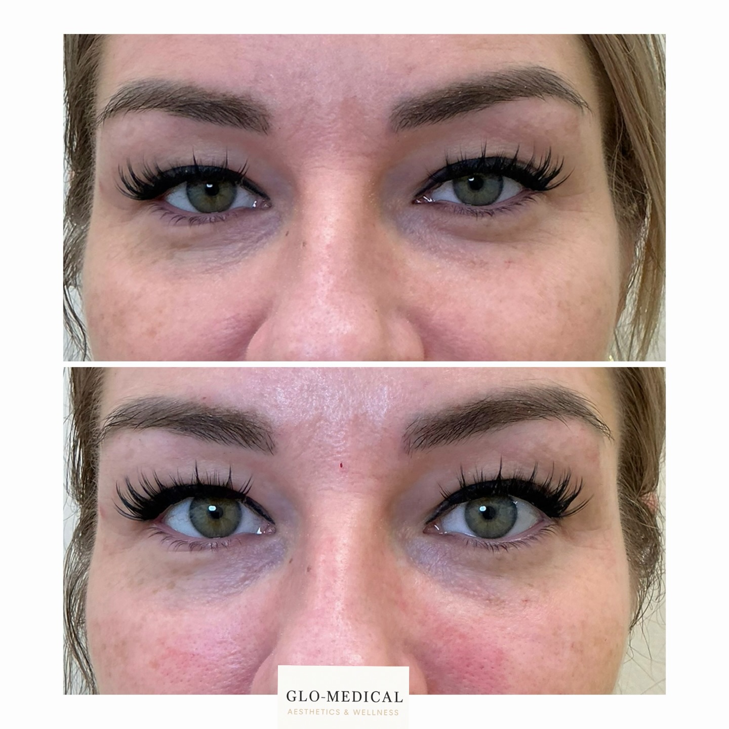 Under-eye refresh ✨
Tear trough filler for subtle, natural-looking correction- Less is more when treating the under eye area 🤍