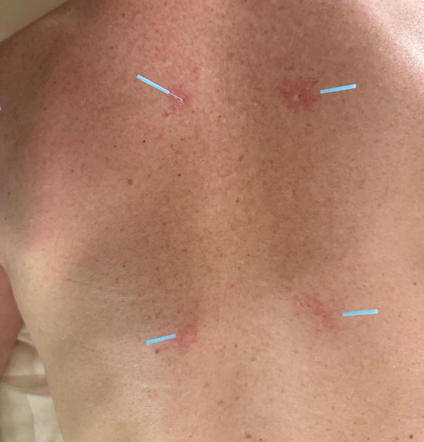 Ever notice a little redness around acupuncture needle sites? 👀
That’s called sha—a natural histamine response and a sign your body is waking up its healing process.
Sha shows increased circulation and immune activity at the area being treated. It’s temporary, totally normal, and often means your body is responding just as it should ✨
At Moment Wellness Acupuncture, we always check in to be sure your treatment feels safe, supported, and effective.
📍Serving Conifer, Evergreen, Bailey Colorado
#Acupuncture #Sha #HealingResponse #MomentWellness #ConiferCO #EvergreenCO #HolisticHealth #ChineseMedicine #NaturalHealing
