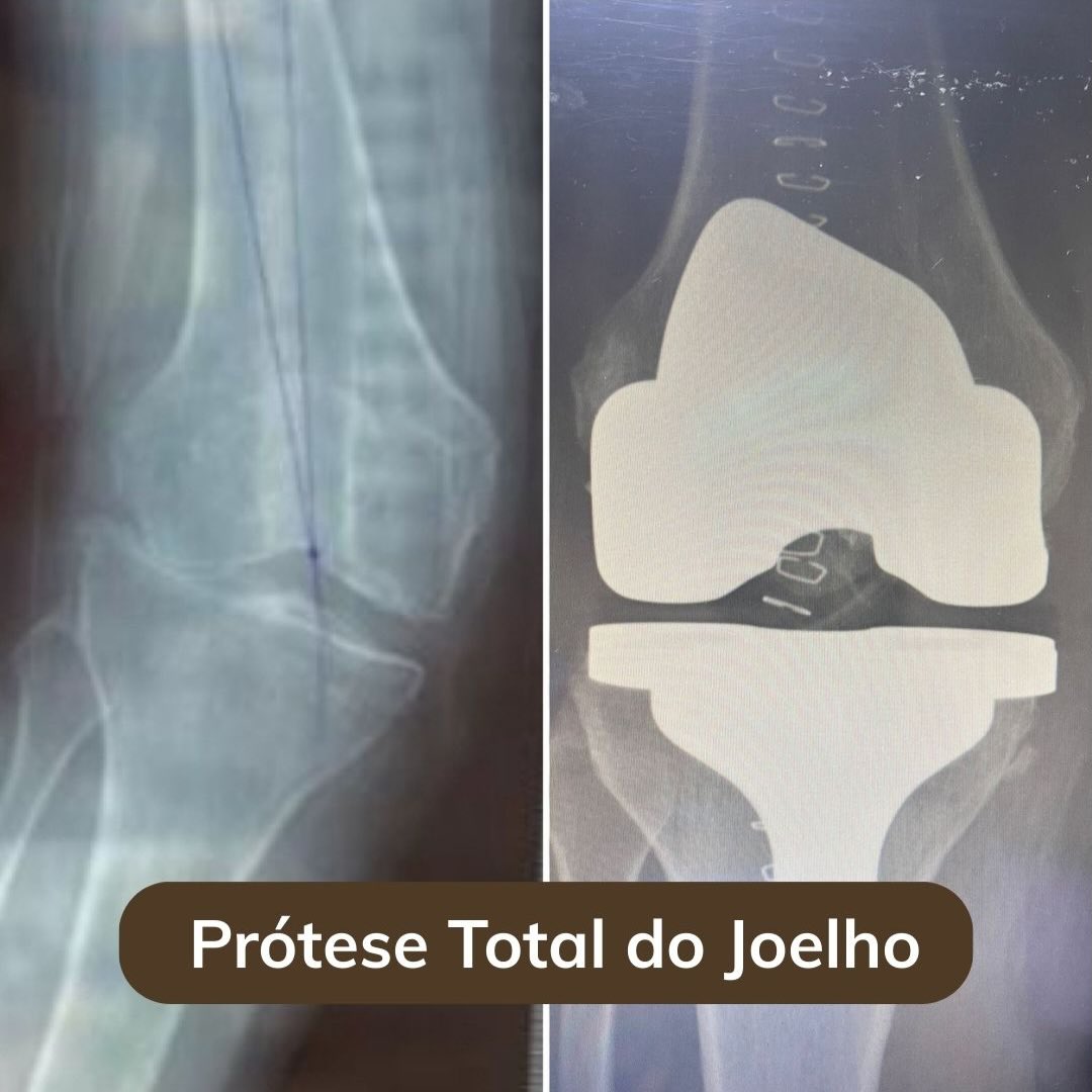 Dores no joelho que não melhoram com fortalecimento, fisioterapia, medicamento ou infiltrações podem ser um sinal de alerta. Quando bem indicada, a prótese do joelho passa a ser uma opção de tratamento.
Ela é indicada principalmente para pacientes com desgaste avançado da articulação, como na artrose, quando a dor é constante e limita atividades simples do dia a dia, como caminhar ou subir escadas. A prótese pode ajudar a reduzir a dor, melhorar a mobilidade e devolver qualidade de vida.
Cada caso precisa ser avaliado com cuidado, considerando-se a história, rotina de cada paciente e expectativas, exame físico, exames de imagem. Se você sofre com dor no joelho, procure orientação especializada e entenda qual é o melhor caminho para o seu caso.
#artroplastia #joelho #cirurgia #protesedojoelho #ortopedia