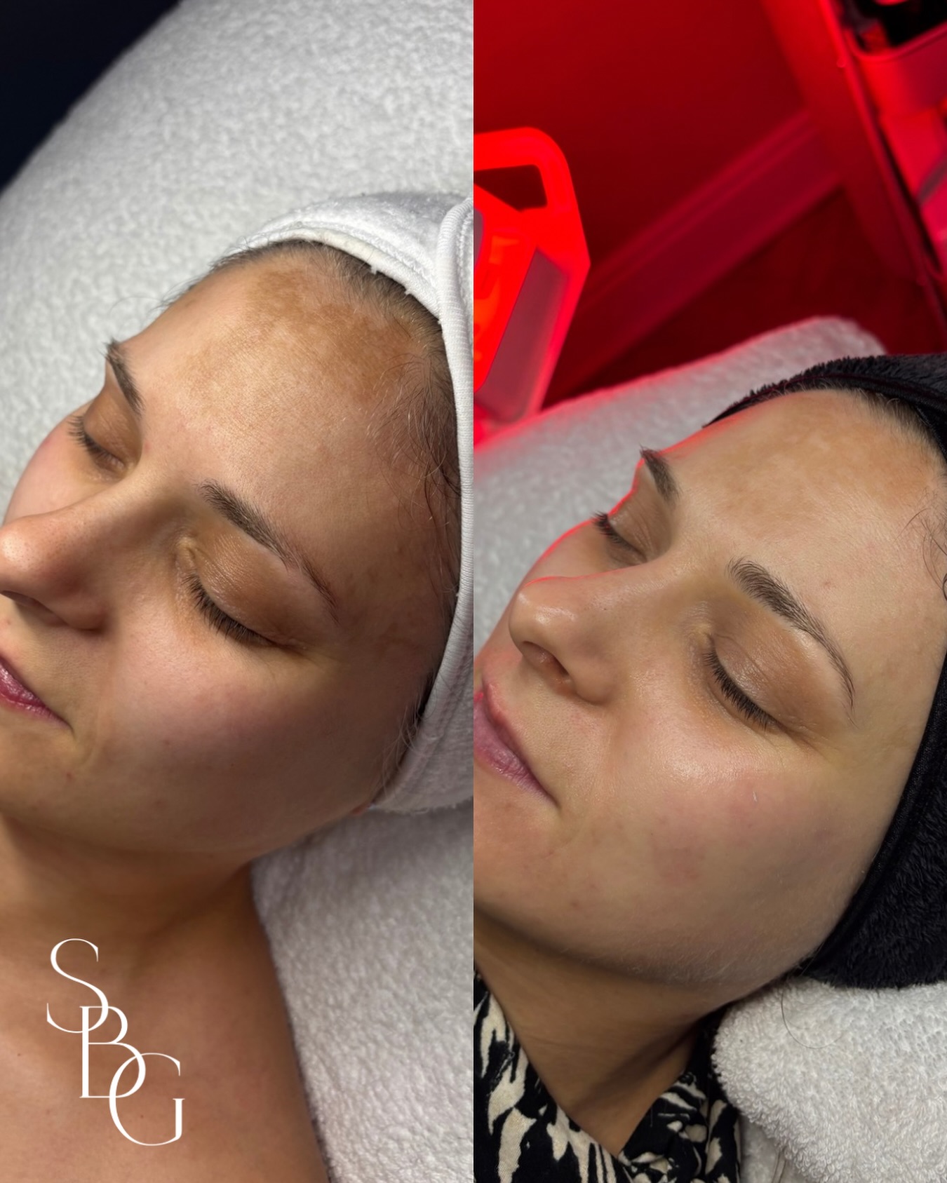 We’re talking Hyperpigmentation Removal using the BioRePeel✨
How amazing are these results in brightening my clients long-standing hyperpigmentation after 5 sessions of BioRePeel!!
I love this treatment for its ability to brighten, clear and resurface without irritating the skin or causing excessive downtime. It’s best suited in courses of subsequent treatments to deliver more intense results
#biorepeel #hyperpigmentation #skinclinicaltrincham #chemicalpeel #acnetreatment