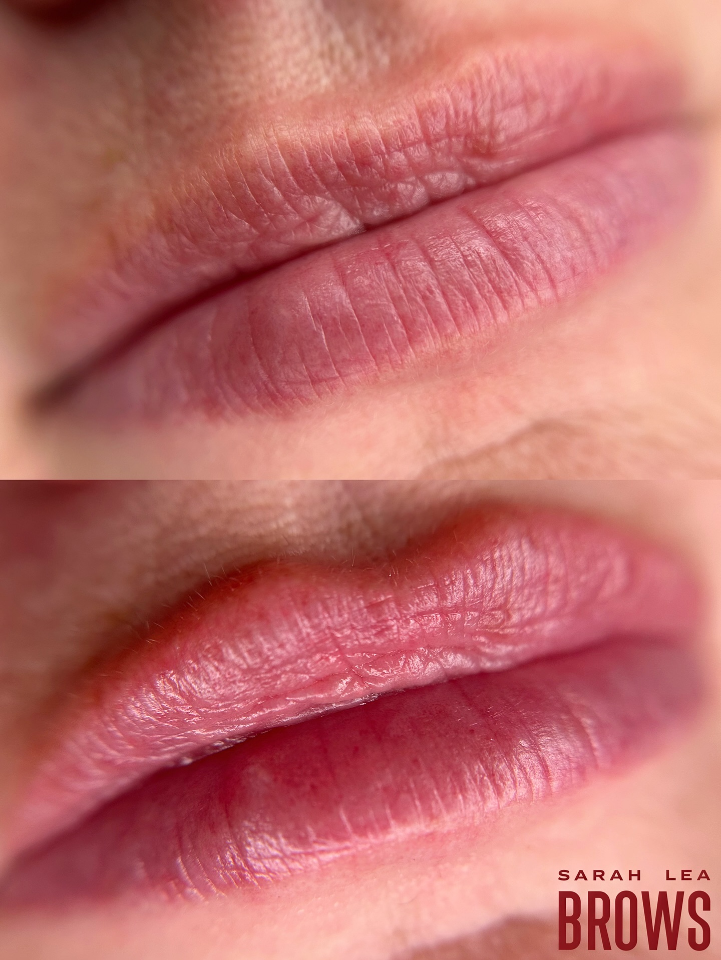 Healed lip blush after one session on my gorgeous client. She did also have a little filler done (@aylas.aestheticss ) between her before and after here, hence the more defined cupids bow. Filler and lip blush are a match made in heaven, tbh. But you can see we have neutralised those purple undertones and added a super natural rosey flush to her lips which has overall brightened her complexion, her lips look more even in tone, volume is increased (this is also helped with the addition of filler too, of course). This is natural and undectable work that just brightens your face overall but without looking like you’ve had somthing done and therefore being distracting. My kind of jam!
~ Lip Blush Tattoo
~ Completely customised colour and shape to suit each individuals wants/needs. Appears bold for 5 days but heals to a soft flush of colour similar to that of a tinted balm
~ Artist: Sarah Lea
~ Lasts 2+ years
~ Anaesthetic used throughout
~ Southport, Gold Coast
~ Bookings & Info:
www.sarahleabrows.com