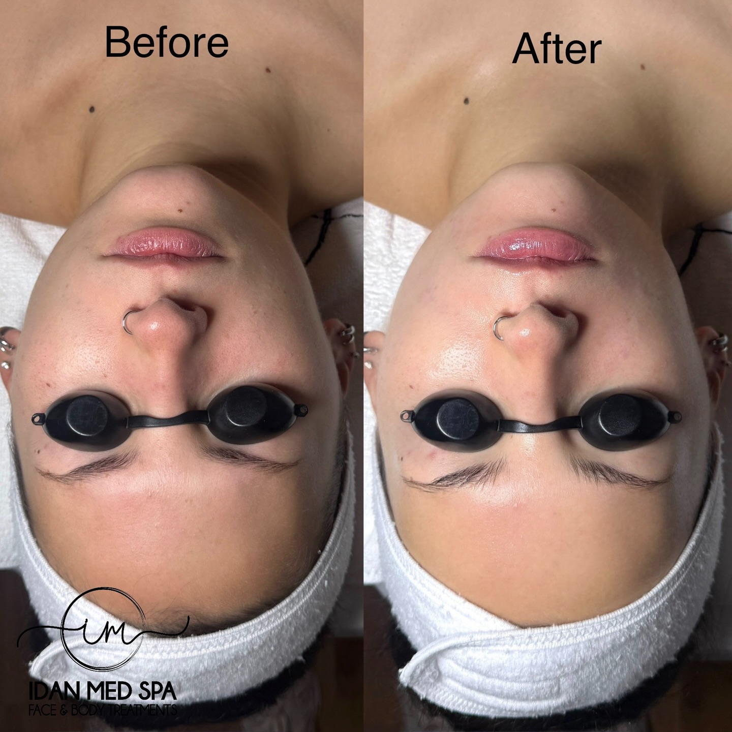 This is what a true HydroFacial can do
✔️ Removes impurities
✔️ Cleans pores
✔️ Infuses skin with oxygen & hydration
✔️ Instant glow, no downtime
📸 Real client before & after
Results may vary, but healthy skin always starts with deep cleansing.
#HydroFacialResults #HealthySkin #MedSpaCare #SkinRejuvenation #BeforeAfterFacial