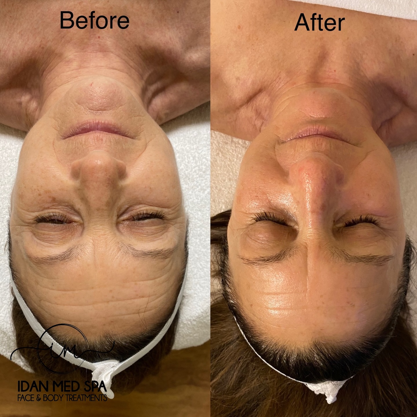 Non-Surgical Facelift ✨
Lift. Tighten. Rejuvenate.
This transformation was achieved with our non-surgical facelift treatment ,no downtime, no surgery, just real results.
📍 Idan Med Spa
📅 Book your appointment today
#NonSurgicalFacelift #SkinTightening #BeforeAndAfter #MedSpaResults #YouthfulSkin