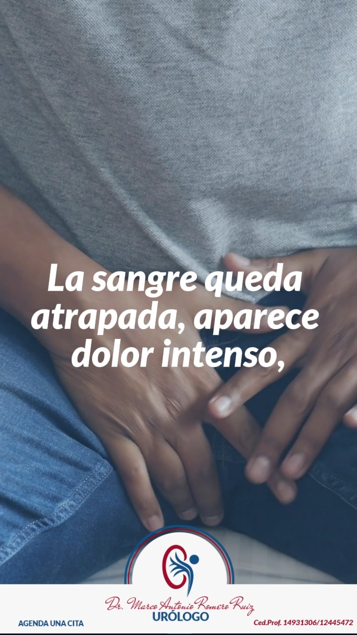 📌 Si una erección dura más de 4 horas, es dolorosa o no desaparece, no lo ignores.
Buscar atención inmediata puede marcar la diferencia entre una recuperación completa o una complicación grave.
Hablar de salud sexual también es cuidarte 💙
📩 Escríbenos por DM y agenda tu consulta.
📱📞442 883 1992 | 331 973 9480
Dr. Marco Romero | Urólogo
Ced.Prof. 14931306/12445472
📍Hospital Star Médica Querétaro
📍Clínica de Especialidades Juan Pablo II. Atlacomulco
#Priapismo #Urología #EmergenciaMédica #SaludÍntima #SaludMasculina