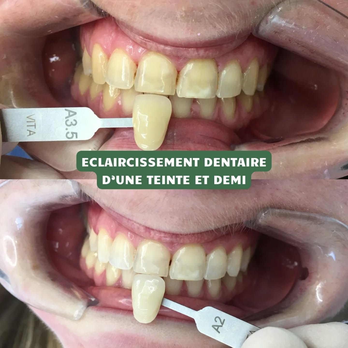 De A3.5 à A2 pour un sourire plus rayonnant.
Éclaircissement dentaire professionnel réalisé au cabinet, avec un protocole sur mesure pour éliminer les colorations (café, thé, tabac) tout en limitant la sensibilité.
Résultat naturel et en toute sécurité.
.
.
.
#roddeetassociés #éclaircissementdentaire #dent #dentist #dentiste luxembourg