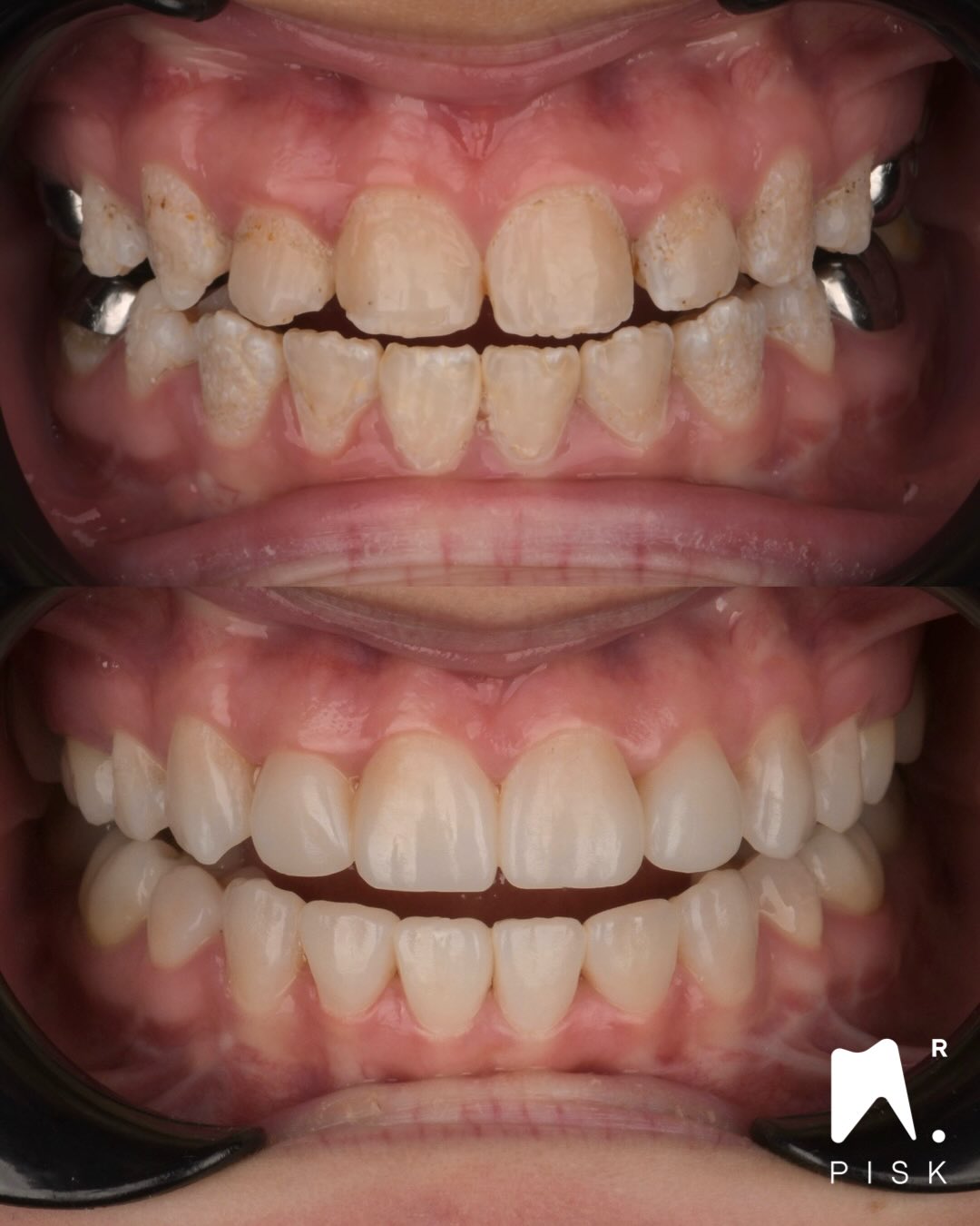 Follow injection group !!
🇫🇷 Amélogénèse imparfaite – Réhabilitation adhésive globale
Cas d’amélogénèse imparfaite avec atteinte sévère de l’émail.
Au vu de la détérioration des dents postérieures, nous avons réalisé des restaurations adhésives en céramique sur les dents 6 et 7.
👉 La dimension verticale actuelle a volontairement été conservée, car je savais dès l’analyse initiale qu’une soustraction d’émail de mauvaise qualité serait nécessaire au cours du traitement.
👉 L’ensemble des autres dents a été restauré par composite stratifié injecté.
👉 La stratégie a reposé sur une approche minimalement invasive, tout en sécurisant l’adhésion.
Matériaux utilisés :
• G-ænial Universal Injectable
• Teintes OA2 et JE uniquement
• Stratification simplifiée, orientée efficacité clinique et reproductibilité.
Si vous souhaitez apprendre cette technique et l’intégrer à votre pratique quotidienne :
🔗 https://formationdentairehdf.com/formations-au-centre/
🇬🇧 Amelogenesis Imperfecta – Full Adhesive Rehabilitation
Case of amelogenesis imperfecta with severe enamel alteration.
Due to posterior deterioration, adhesive ceramic restorations were performed on molars (6 and 7).
👉 The existing vertical dimension was deliberately preserved, as I anticipated from the initial diagnosis that removal of poor-quality enamel would be required during treatment.
👉 All remaining teeth were restored using injected stratified composite.
👉 The treatment strategy followed a minimally invasive adhesive approach, ensuring long-term adhesion.
Materials used:
• G-ænial Universal Injectable
• Shades OA2 and JE only
• Simplified stratification, focused on efficiency and reproducibility.
If you want to learn this technique and apply it in daily practice:
🔗 https://formationdentairehdf.com/formations-au-centre/