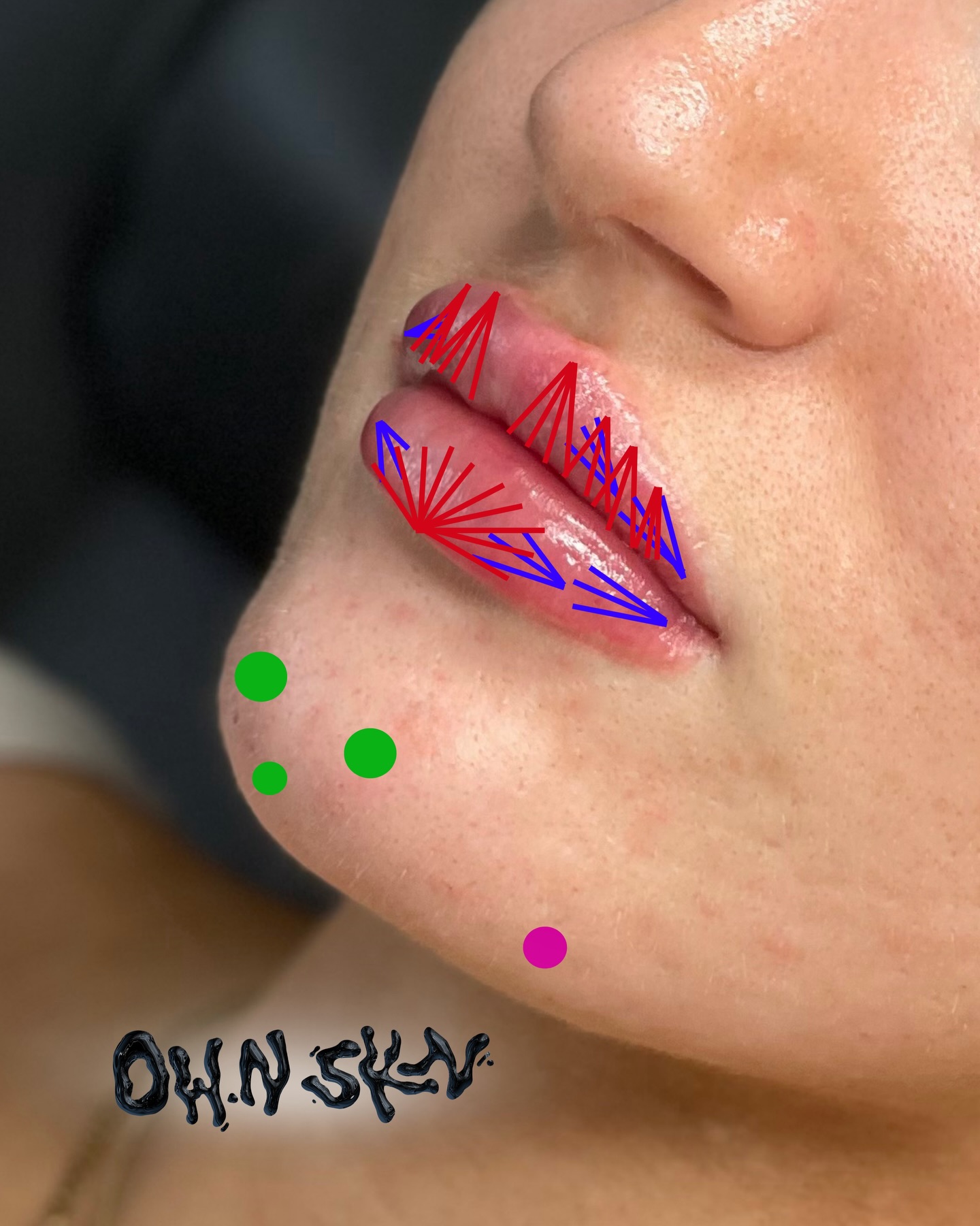 Technique matters 💉🫦
1.1ml Chin & 0.5ml The Pout 💋
• Vertical lip filler forms the building blocks for height and shape
• Horizontal lip filler placement creates that signature projection for a soft, pouty finish 💋
• Chin filler to project the chin forwards for a more balanced side profile & placement at a downward 45° angle to extend the chin and enhance a subtle V-line front profile 📐
• Pre-jowl bolus smooths the transition between the jawline and chin for a sharper, cleaner contour ✅
Everything working together for harmonious, balanced, beautiful results 😍
Swipe • Save • Enquire ➡️
Link in Bio or DM to Book ❤️
#chinfiller #lipfillerswestsussex #aestheticsburgesshill #aesthetics #lipgoals