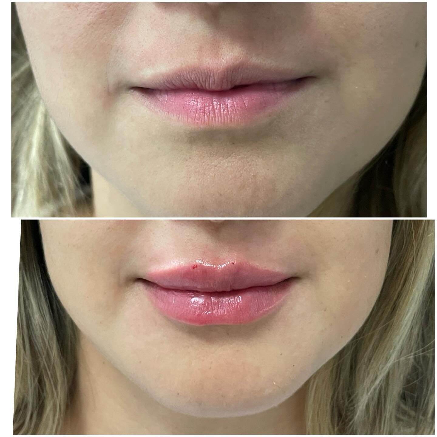 Labios 👄
Solo si son necesarios.
Los labios no deberían ser lo que más resalte en tu rostro,
deben ser un complemento de tu belleza, no el protagonista.
No a los procedimientos hechos solo por moda.
Sí a los labios que respetan tu anatomía, tu edad y tu expresión.
La verdadera elegancia en medicina estética es que nadie note el procedimiento,
solo que te veas más fresca, armónica y natural ✨