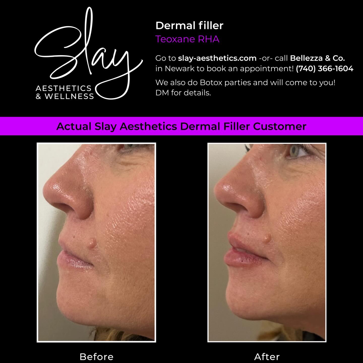 Subtle. Balanced. Still you. ✨
This is what lip filler should look like—soft enhancement, natural shape, and hydration without overdoing it.
Actual Slay Aesthetics patient • RHA
📍 Newark, OH
💉 DM to book or visit slay-aesthetics.com