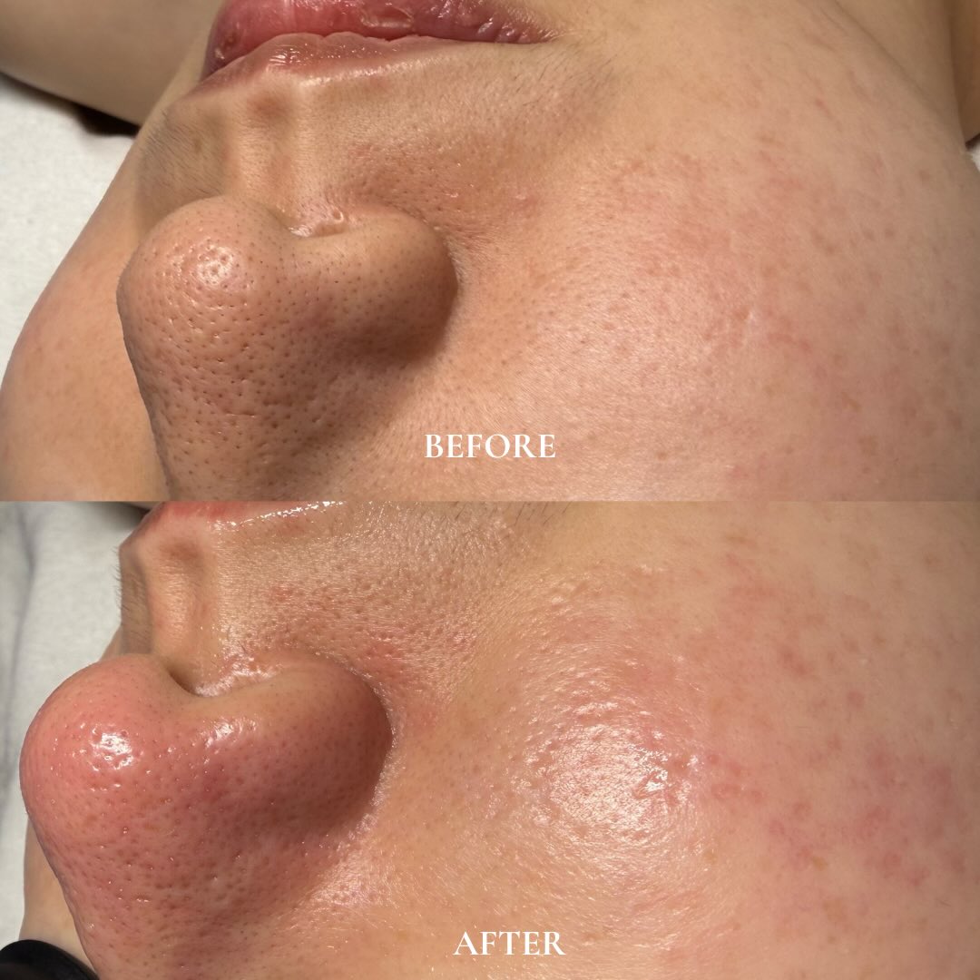 Clean pores. Clear skin. Lasting glow. ✨
HydraFacial combined with expert extractions for a deeper cleanse and longer-lasting results🪄🩵
#hydrafaci̇al #facial #glowingskin