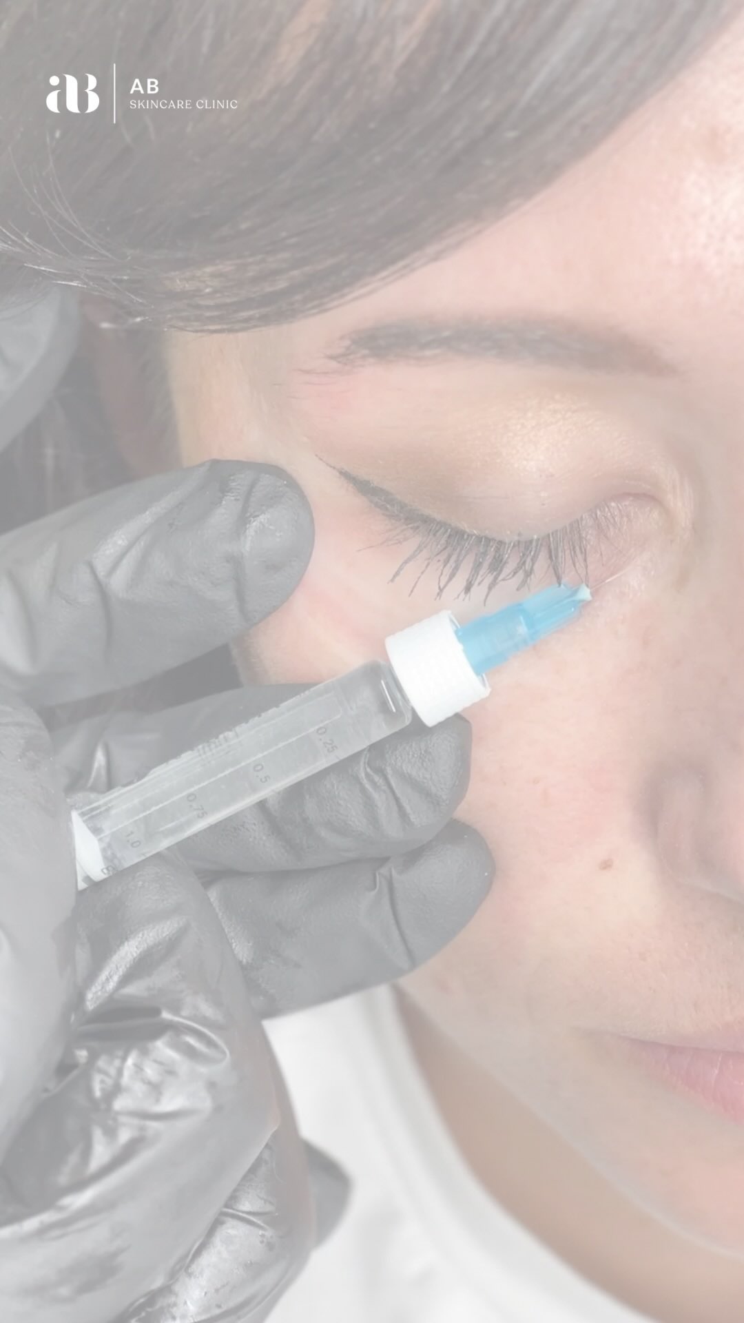 True under-eye regeneration 👁✨
Polynucleotides are an advanced regenerative treatment that works at a cellular level to restore, strengthen and refine the delicate eye area. By stimulating collagen and improving skin quality from within, polynucleotides deliver a brighter, smoother, more youthful appearance – without adding volume.
Expect:
✨ Refined texture
✨ Improved elasticity
✨ Brighter, healthier-looking eyes
✨ Long-term skin regeneration
For those who want timeless results, not temporary fixes.
AB Skincare Clinic
📍Talbot Green
📧april@abskincareclinic.co.uk
📲07763047220
