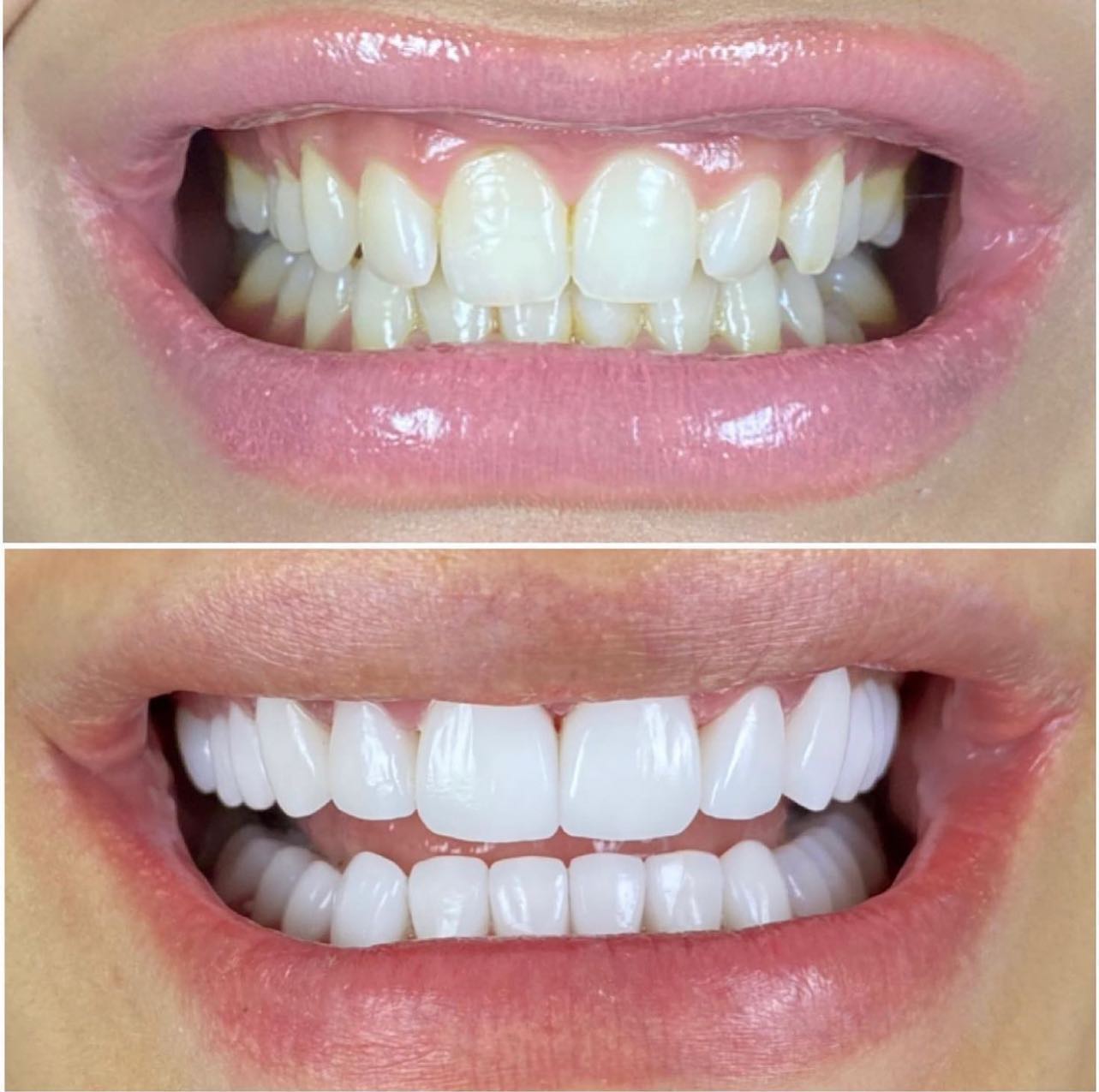 20 EMAX Veneer Before/After of one of our many patient from all over the world.
-
https://www.veneers.istanbul
-
WhatsApp: 00905330164562
-
#veneers #smiledesign #cosmeticdentistry #restorativedentistry #emax #veneer #laminates #zirconia #zirconium #hollywoodsmile #dentalcrowns #crowns #veneersistanbul #porcelainveneers #emaxveneers