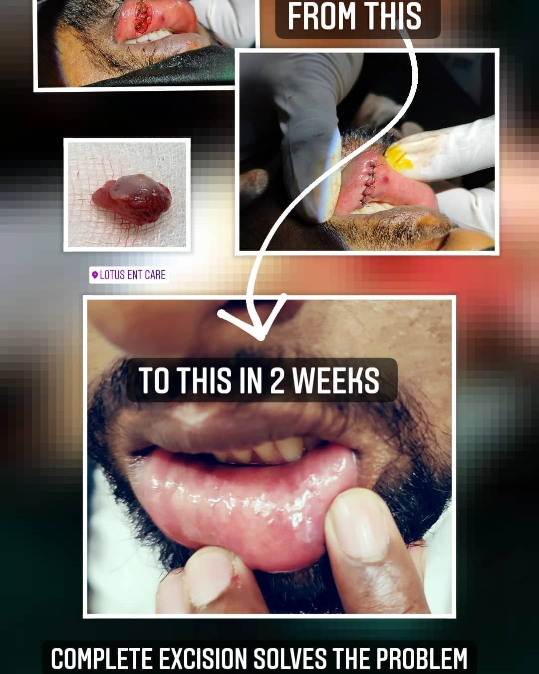 The mucous retention cyst after surgery and in 2 weeks has healed well.
All you need to do is a complete excision of the cyst and to ensure one doesnt continue lip chewing habits .
Do call us to know more
99008735781
www.lotusentcare.com